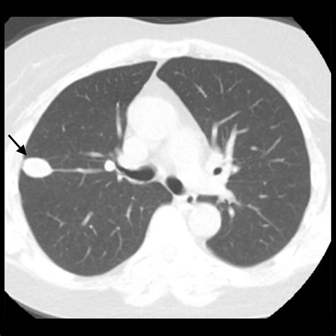Ct Chest Without Contrast
