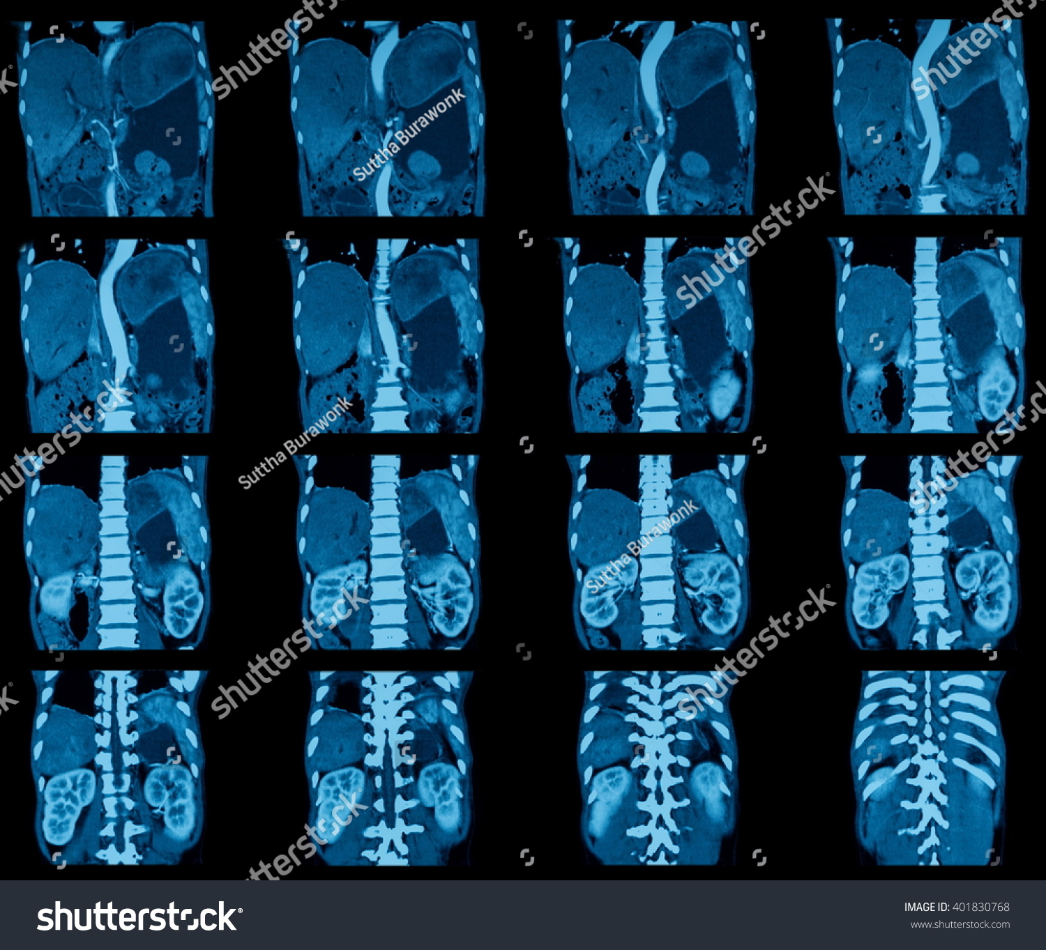 Ct Scan For Abdominal Pain