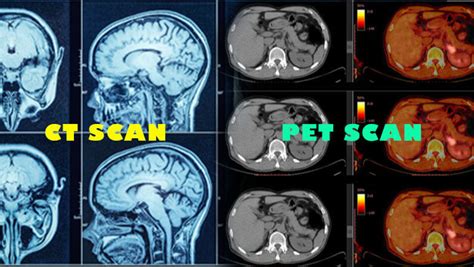 Ct Scan Vs Pet Scan - Face Surgery