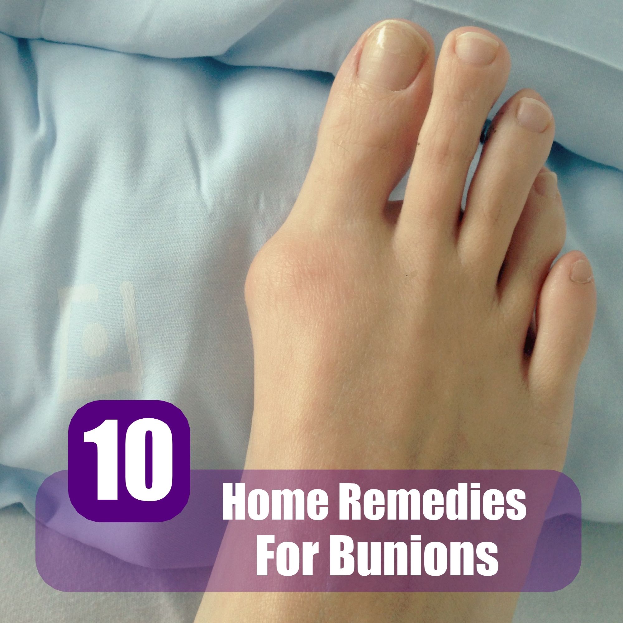 Cure Bunions Home Remedies