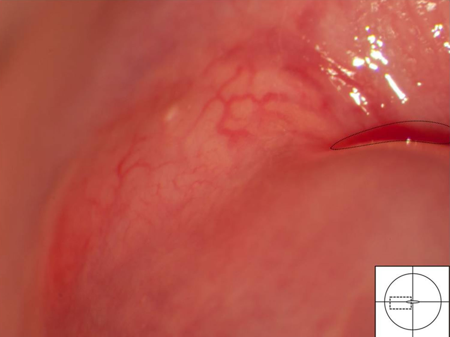 Cyst On Cervix