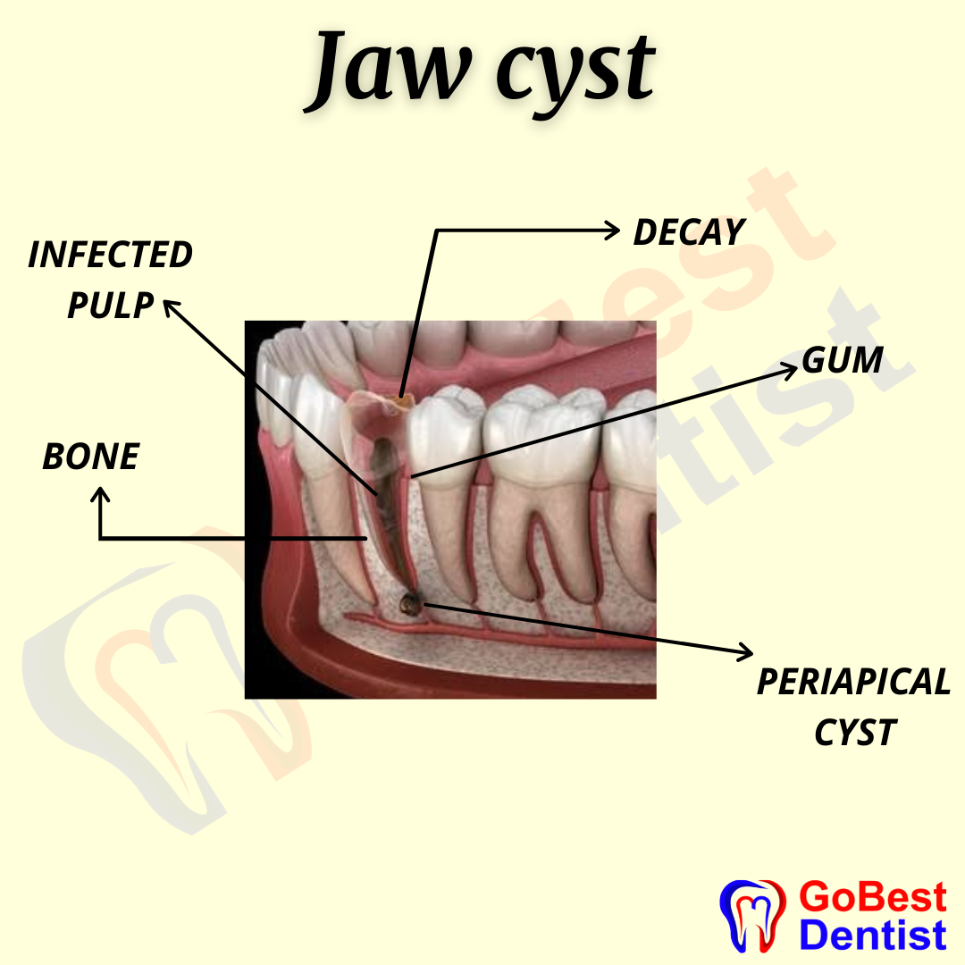 Cyst On Gum