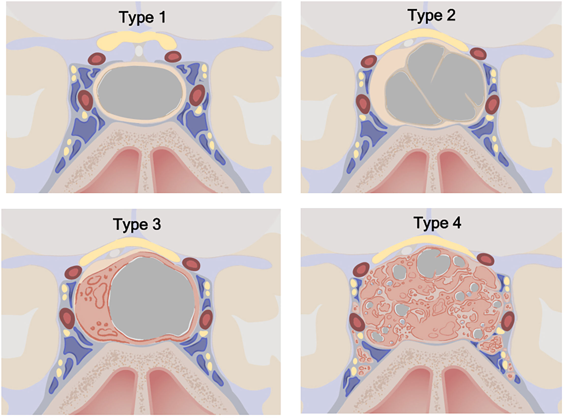 Cyst On Pituitary Gland
