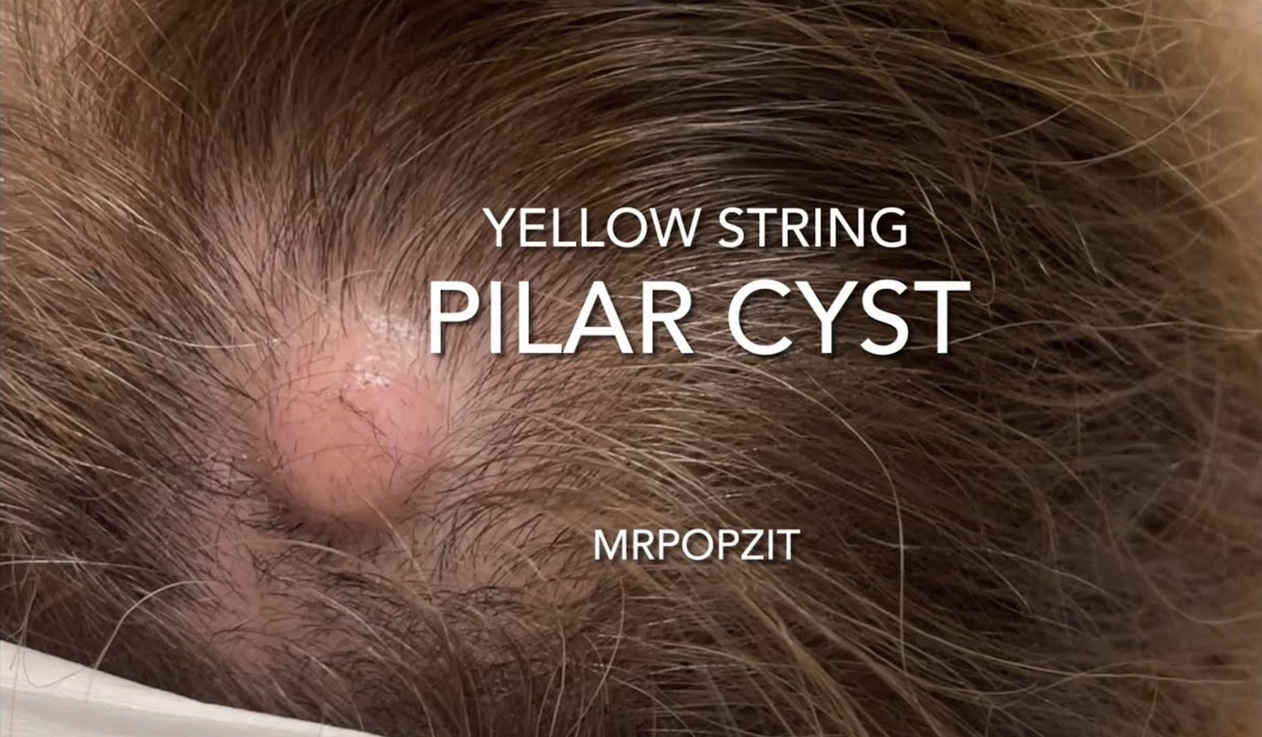 Cyst On Scalp