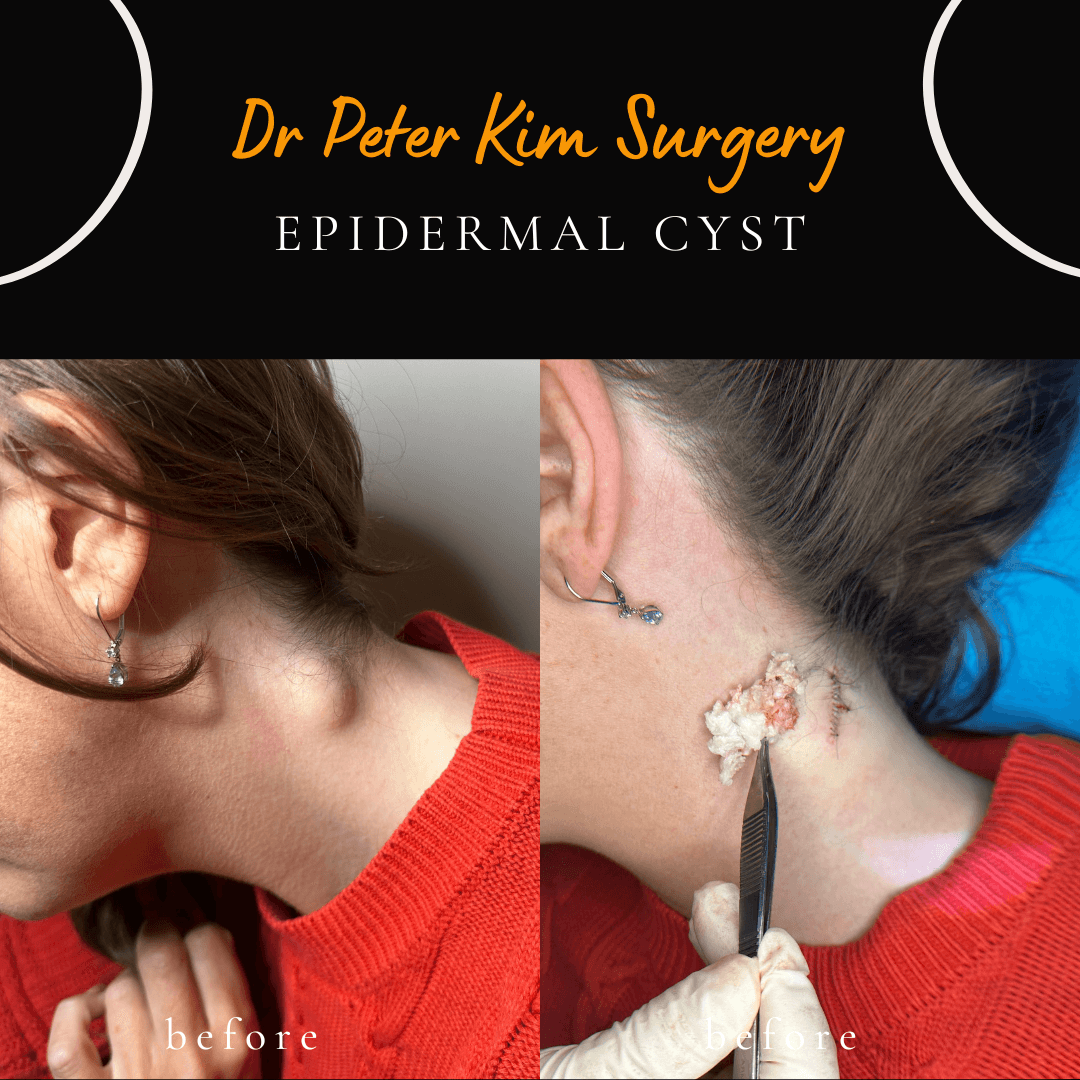 Cyst Removal Surgery