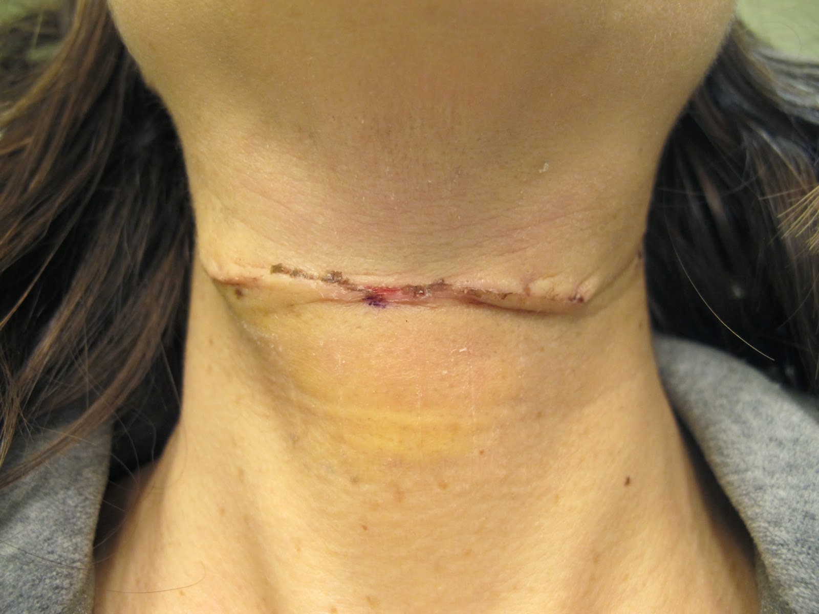 Cyst Trunk Operation