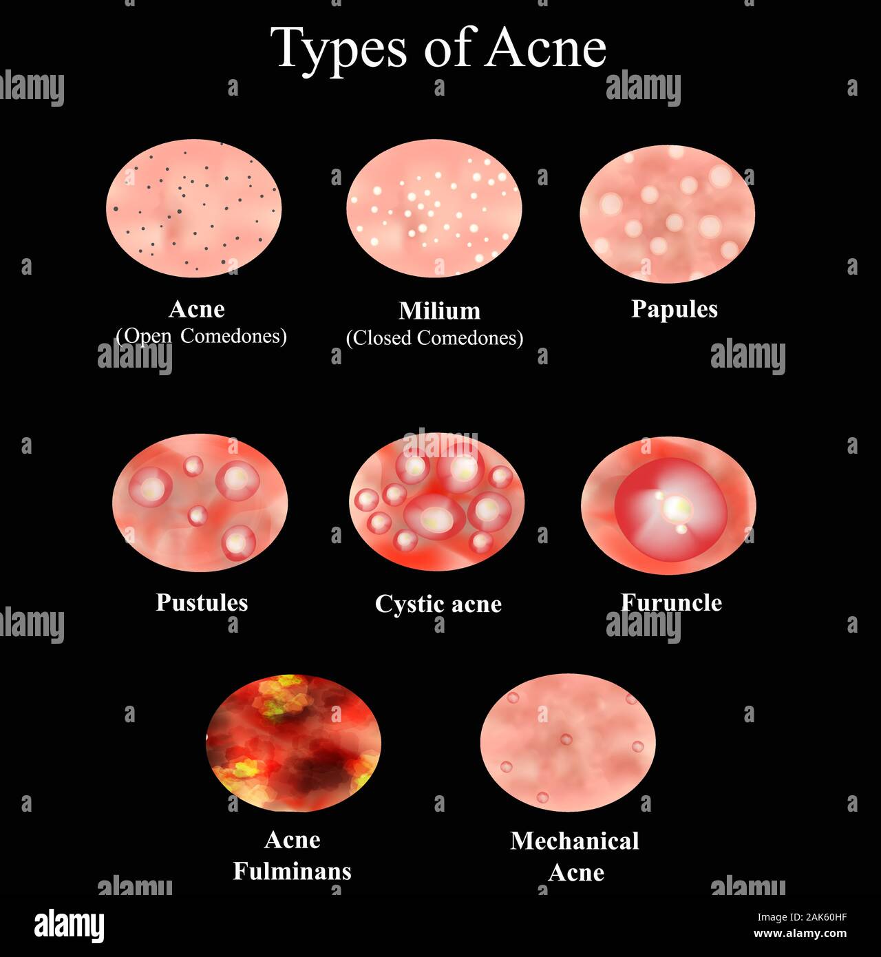 Cystic Acne Dermatology