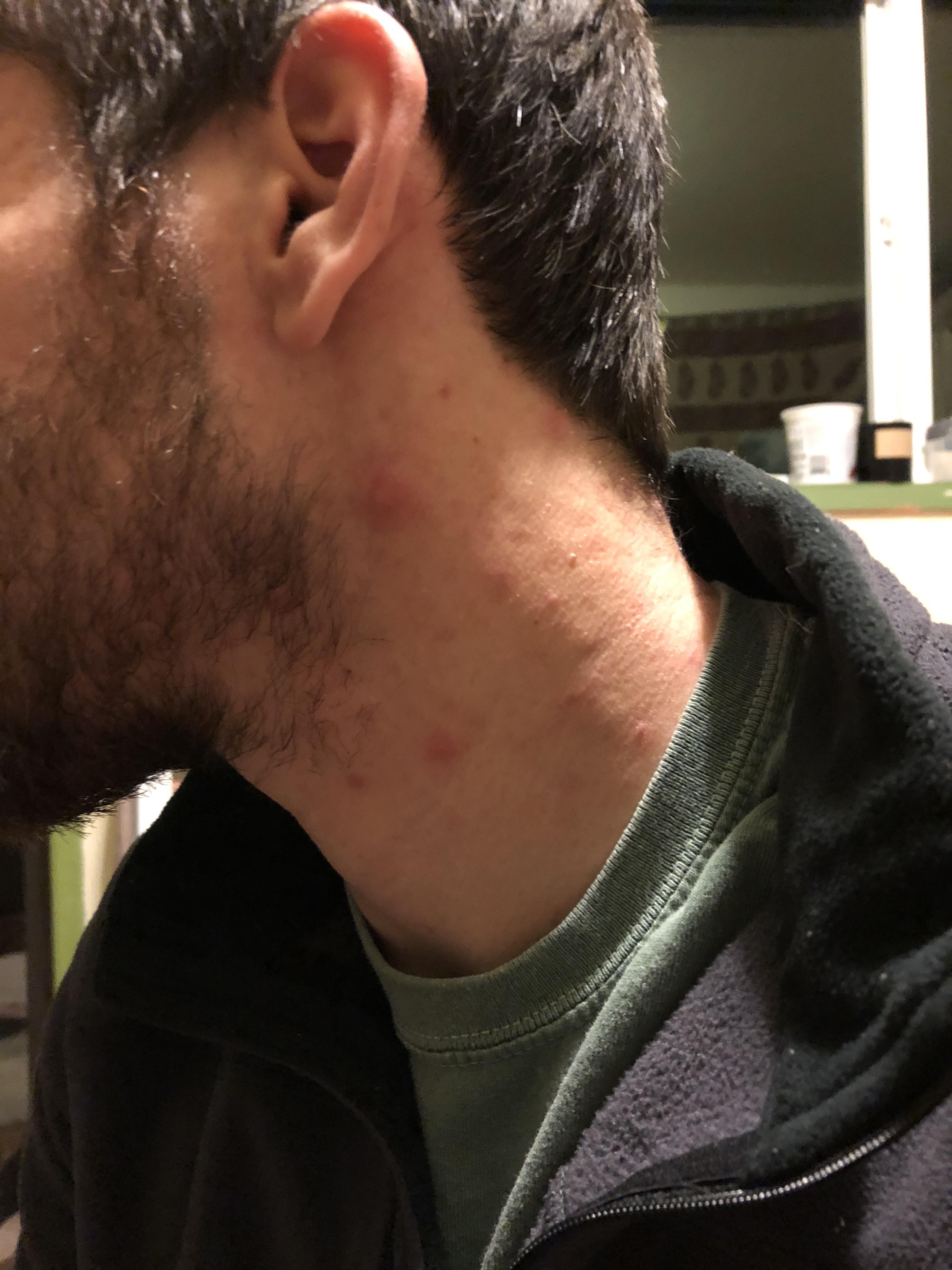 Cystic Zits On Neck