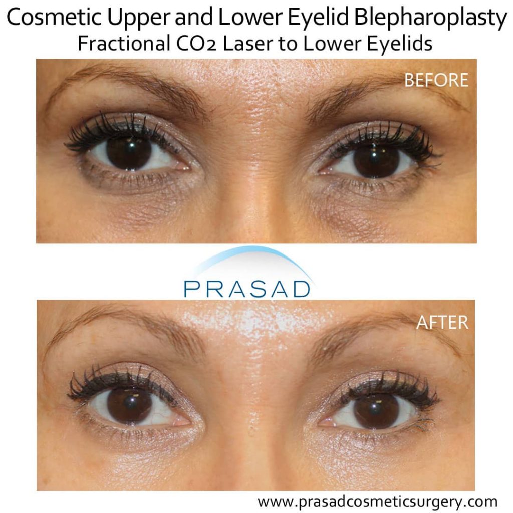 Dark Eye Laser Treatment