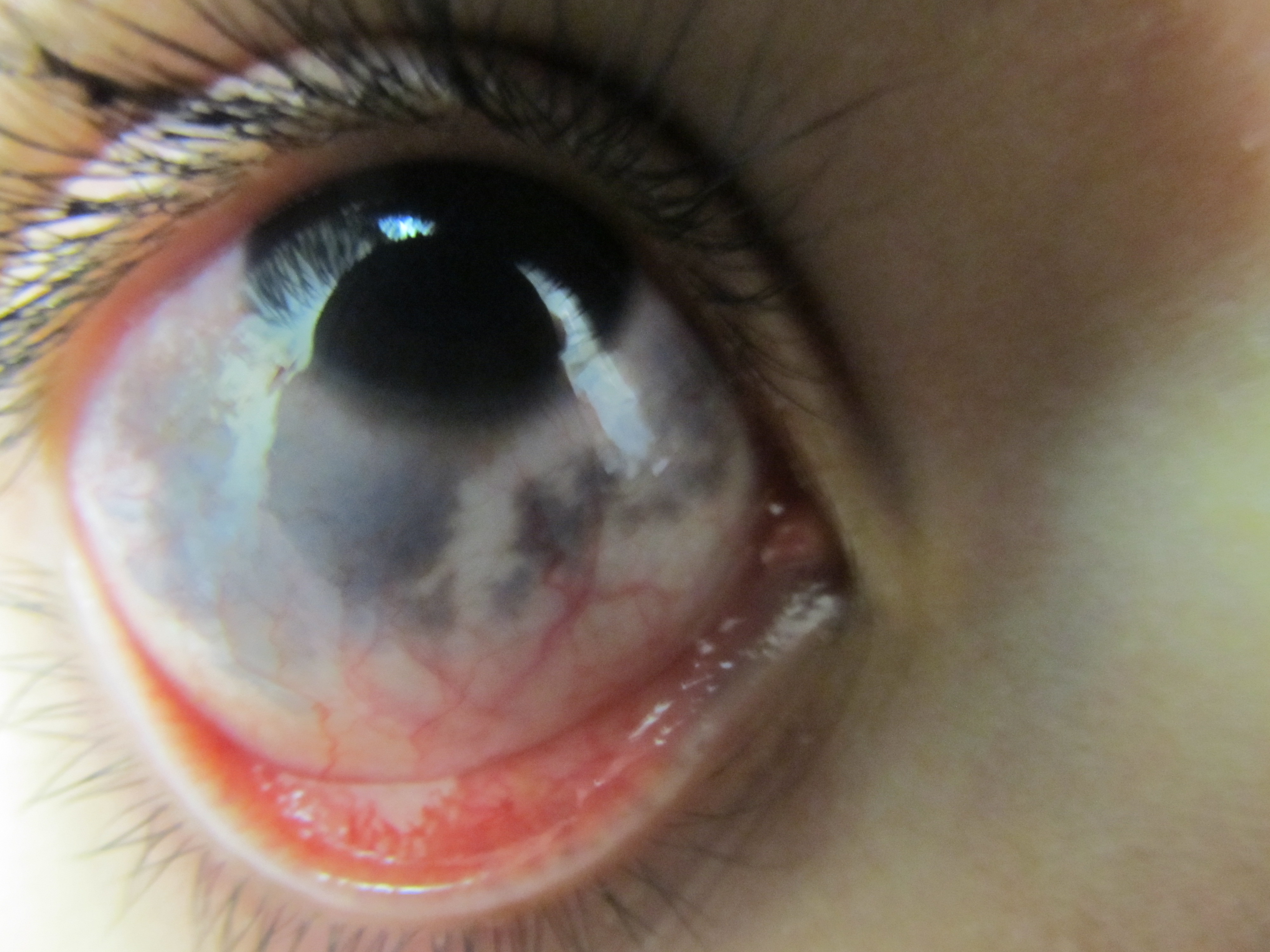 Dark Patch On Eye White