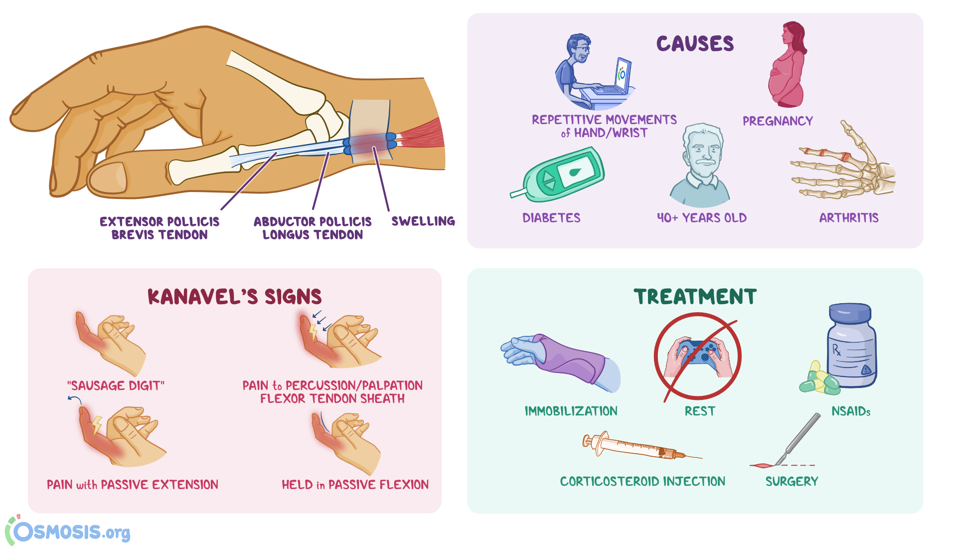 De Quervain's Tenosynovitis Test