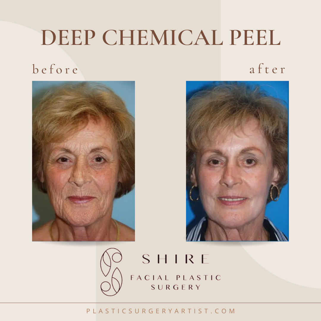 Deep Chemical Peel