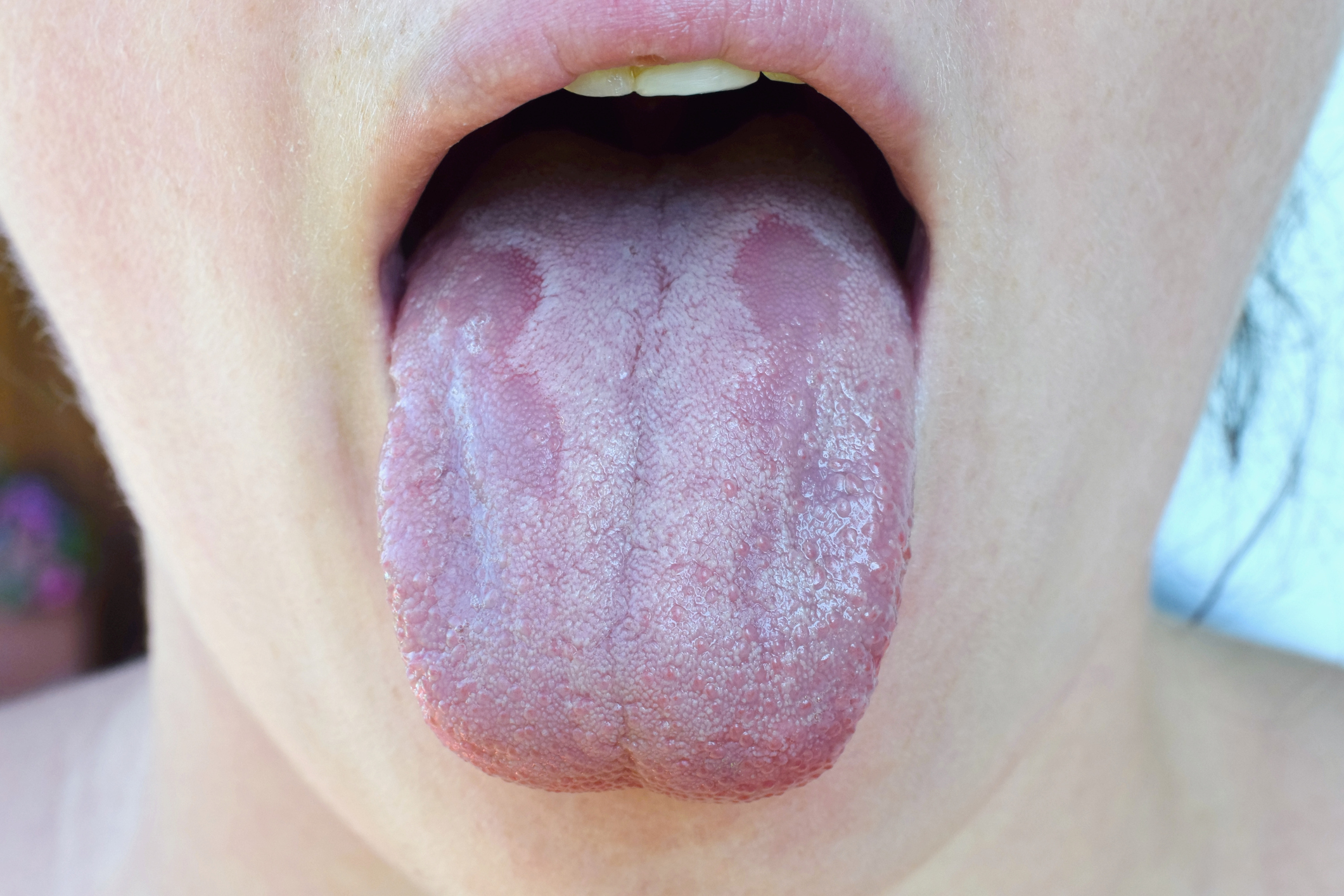 Dehydration White Tongue