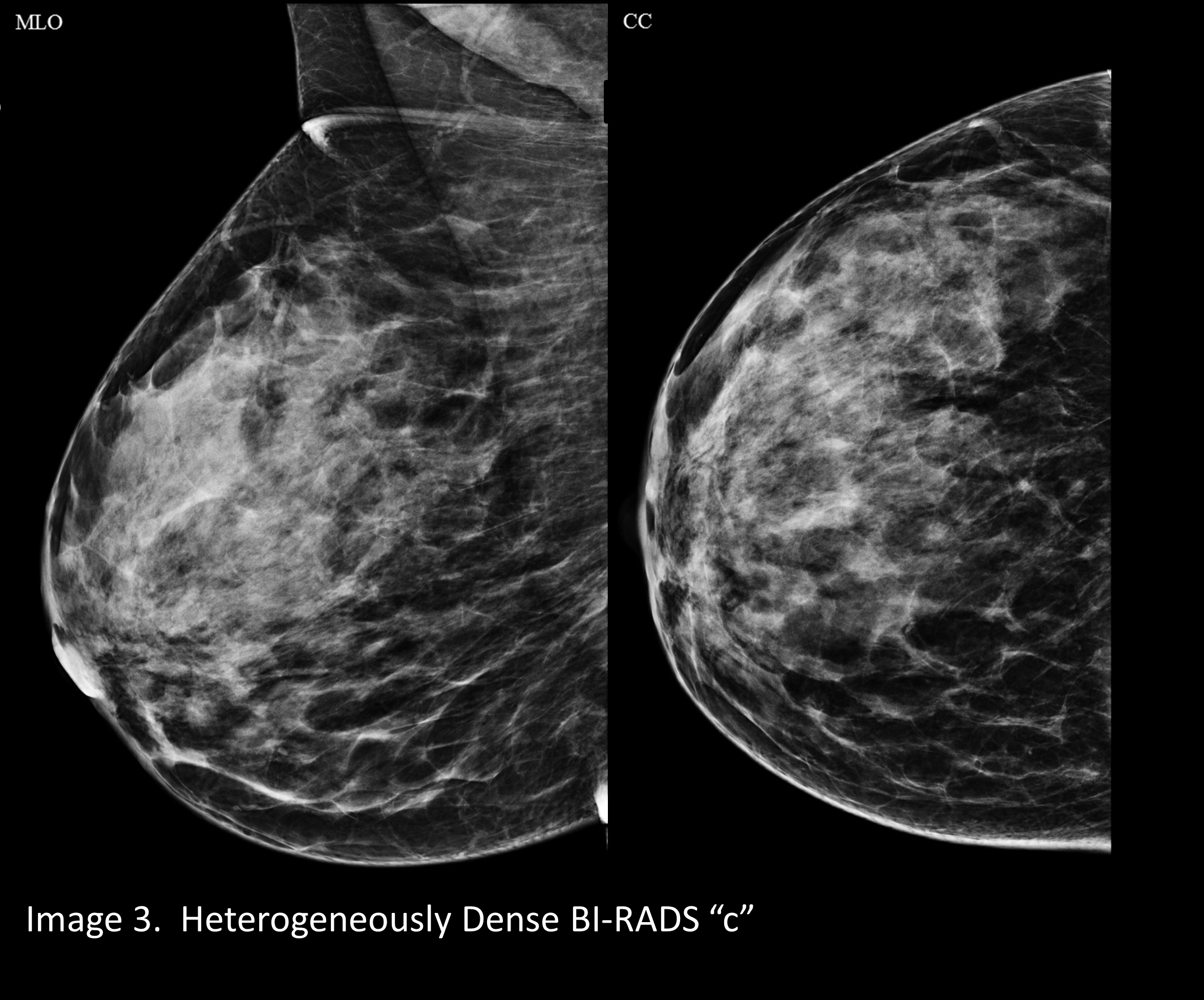 Dense Breasts 3D Mammogram