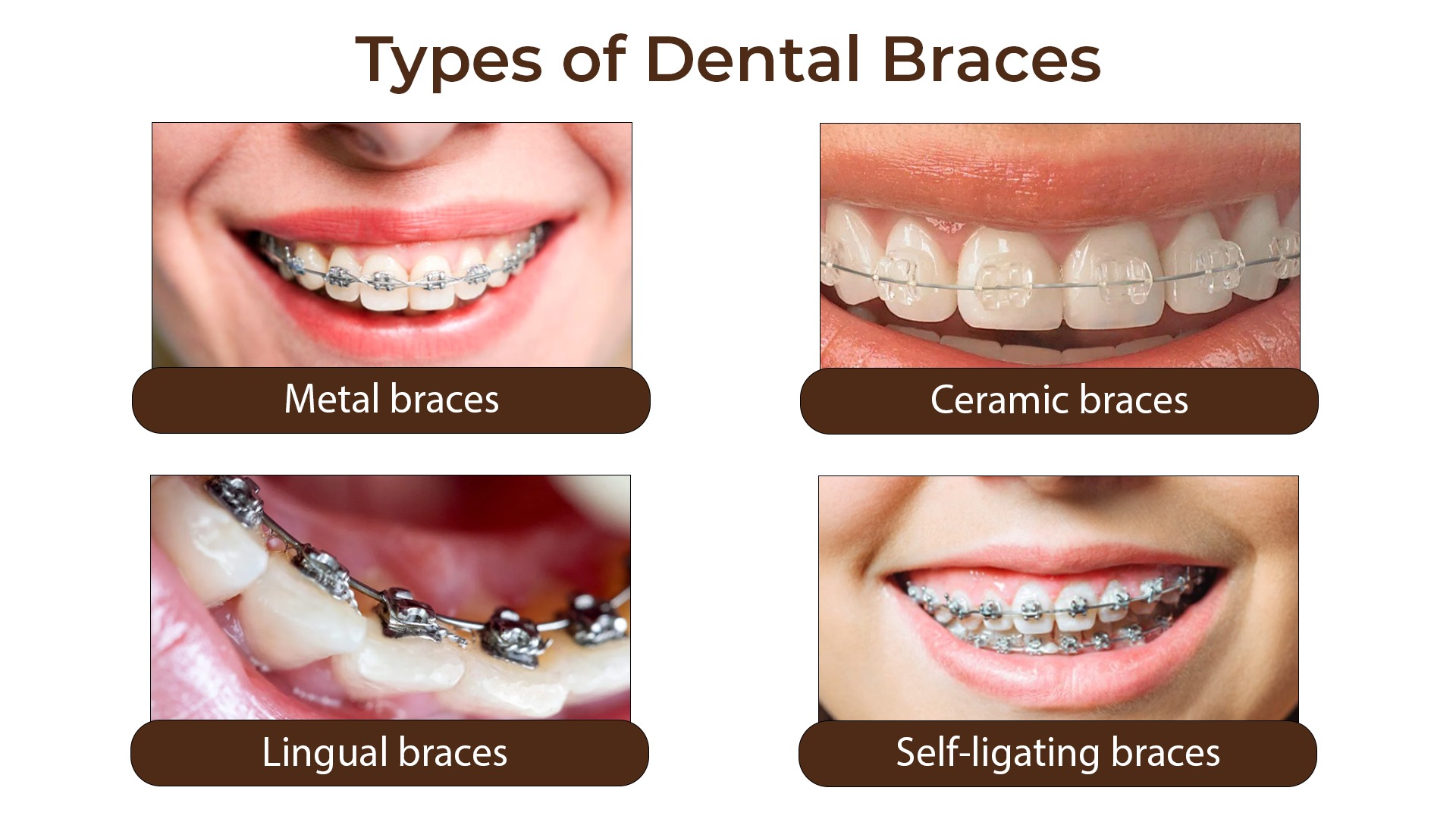 Dental Braces Types