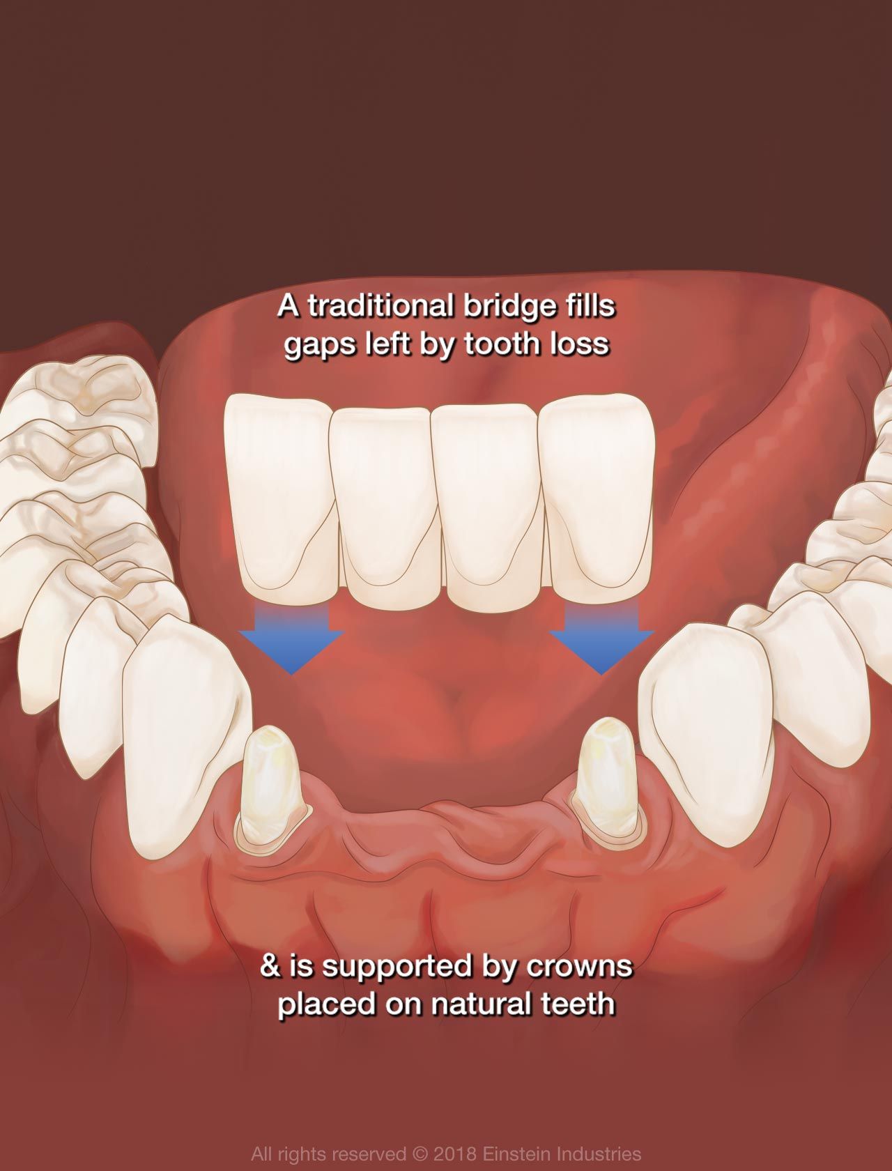 Dental Bridge Front Teeth