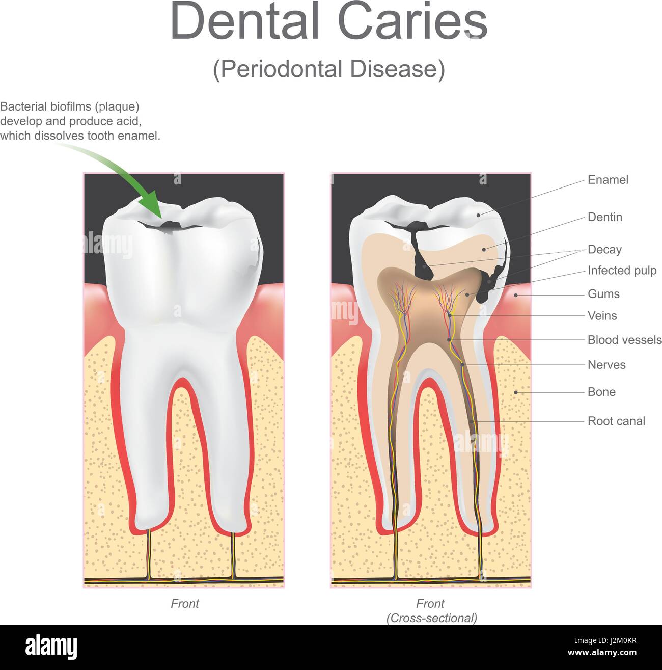 Dental Cavities Images