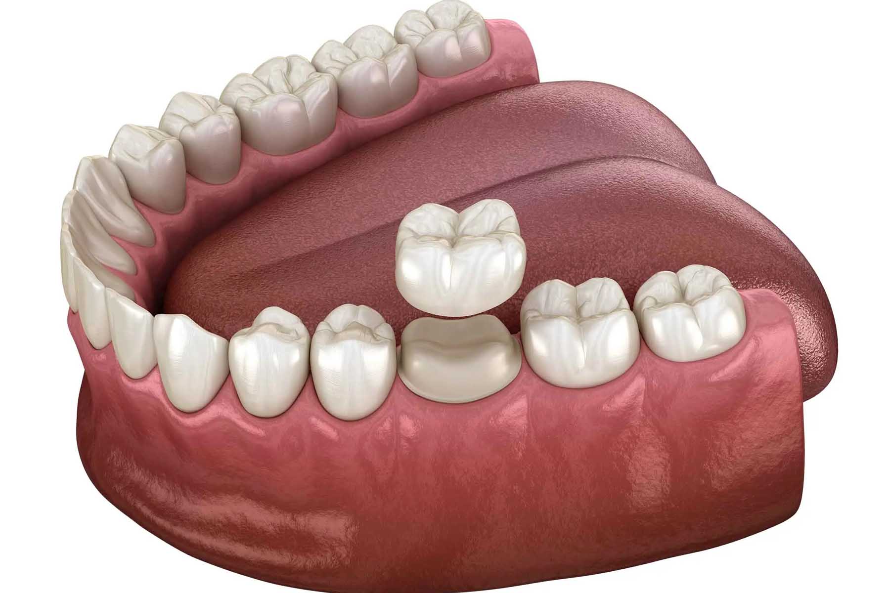 Dental Crown Procedure