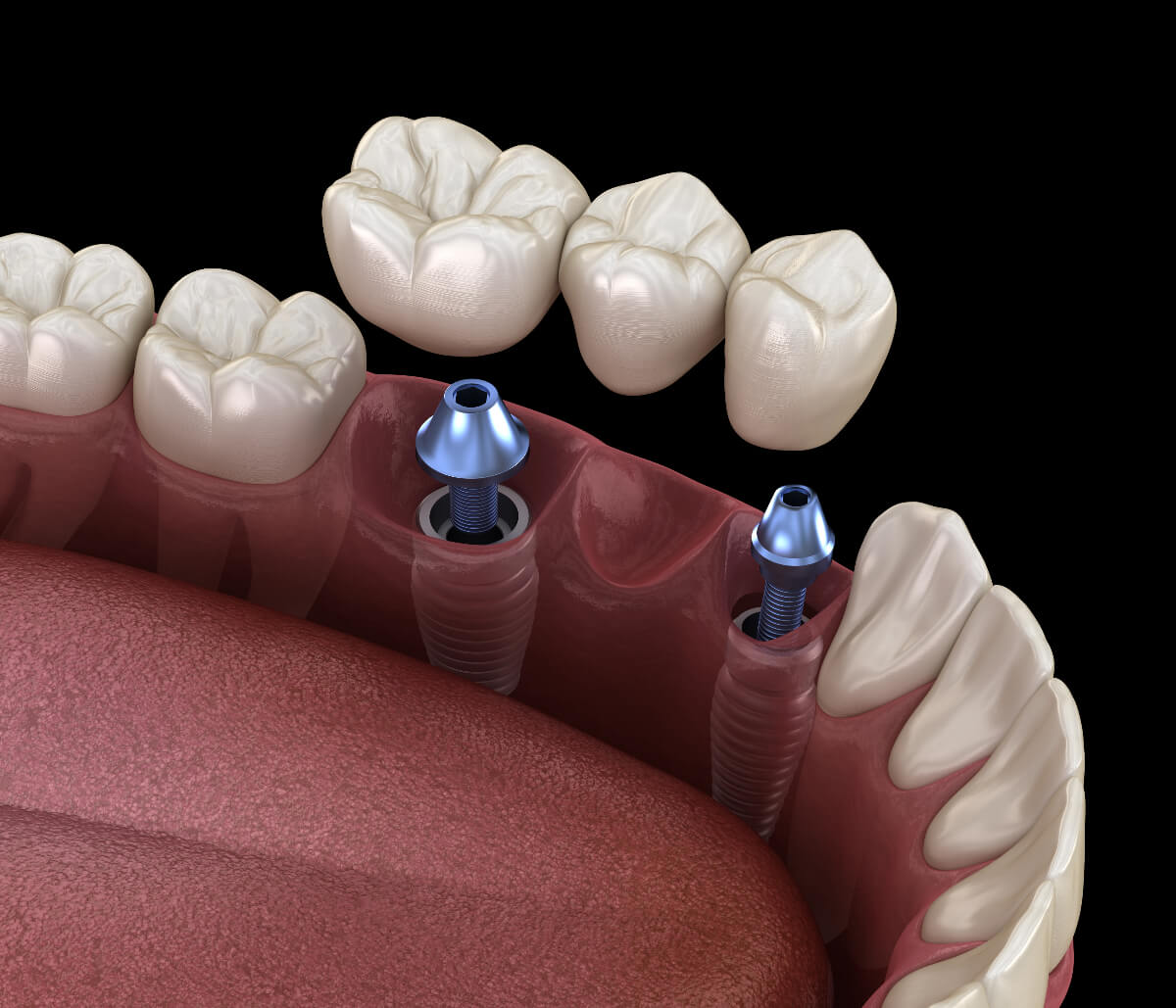 Dental Implant Crown