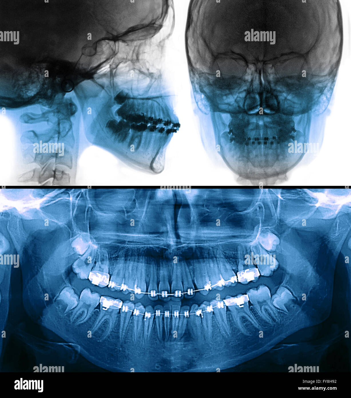 Dental Panoramic X Ray