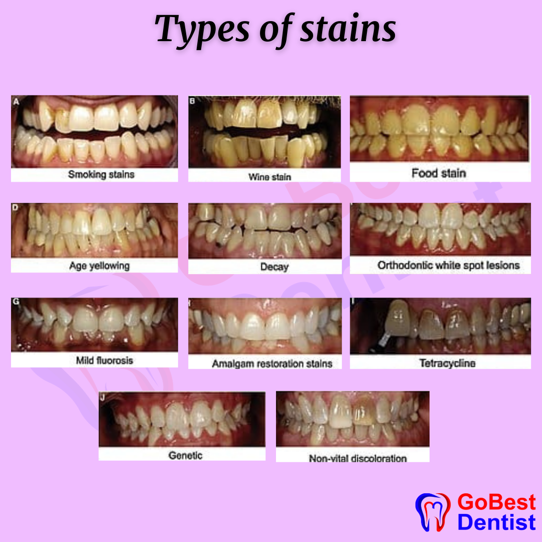 Dental Stains And Discolorations