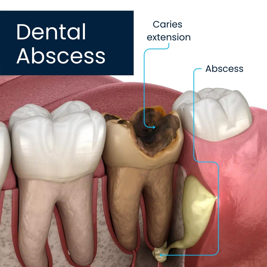 Dentist For Abscess