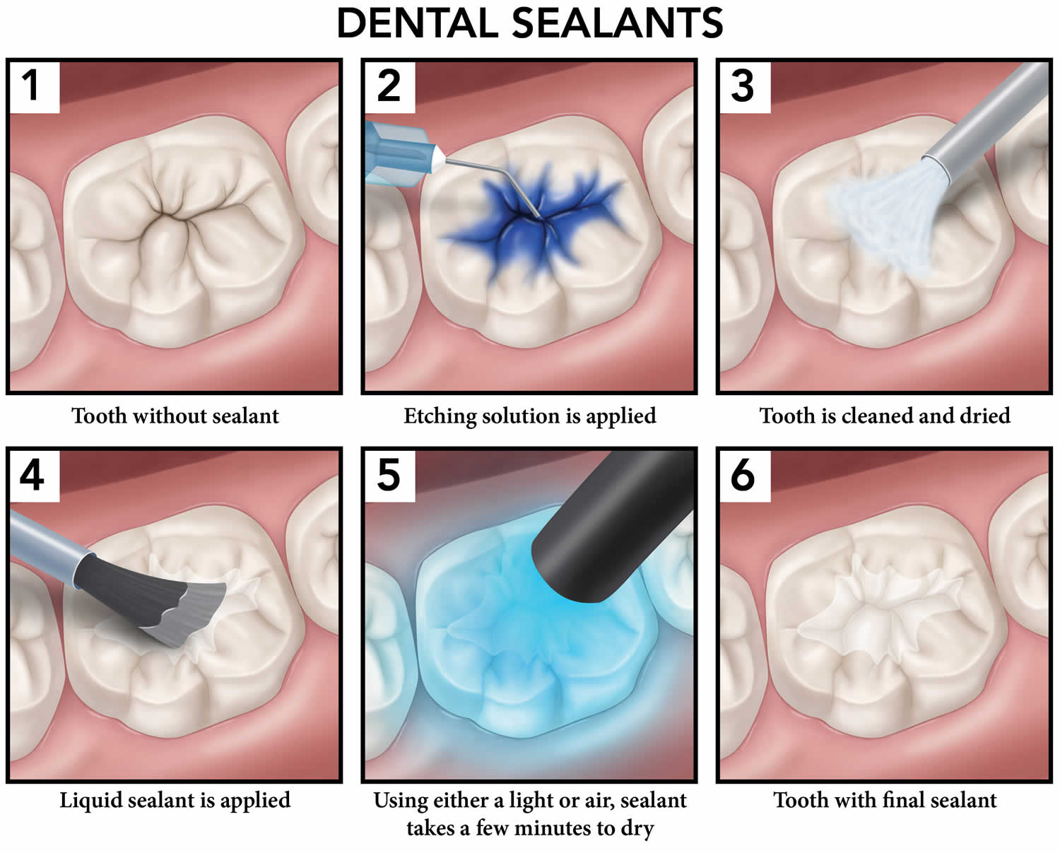 Dentist Sealant Teeth
