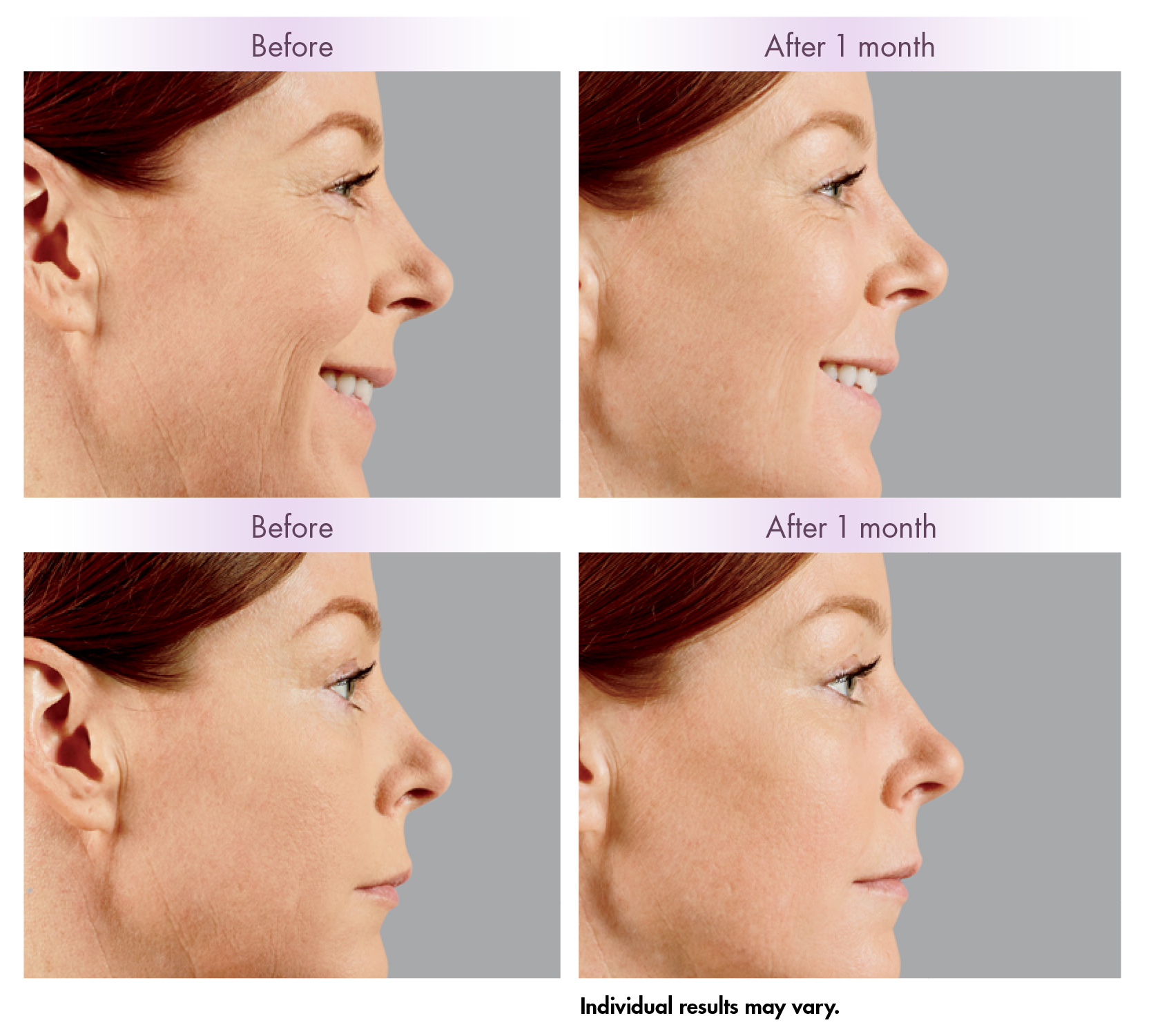 Dermal Filler Cheek