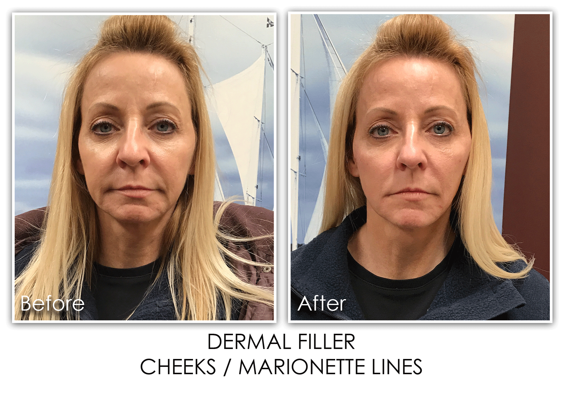 Dermal Filler Cheeks