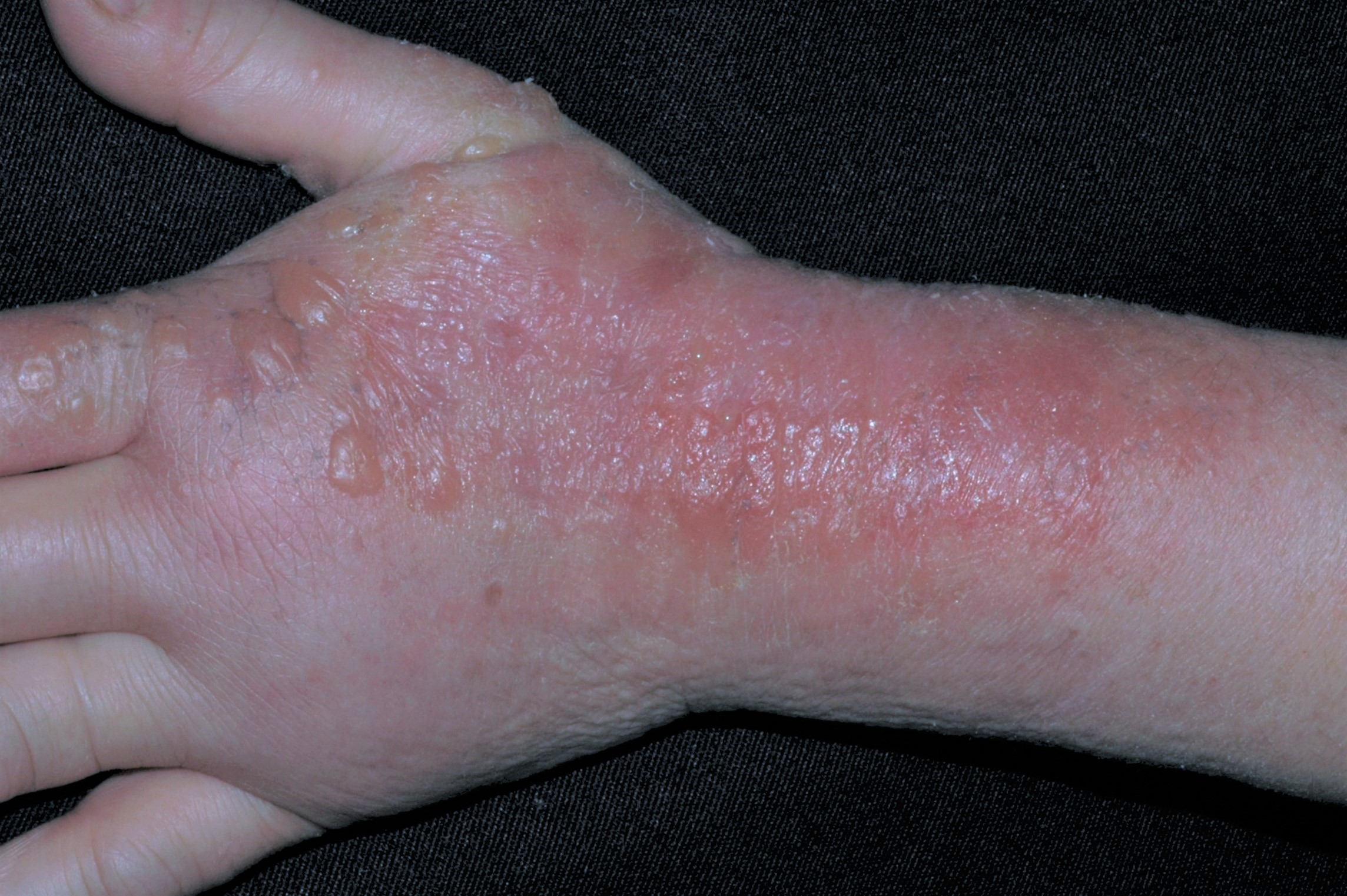 Dermatitis De Contacto