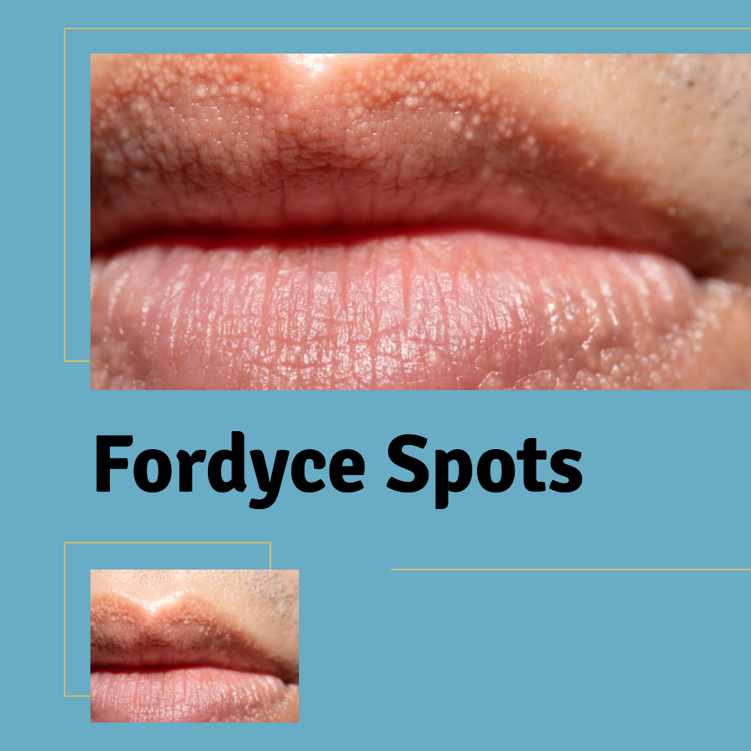 Dermatologist For Fordyce Spots