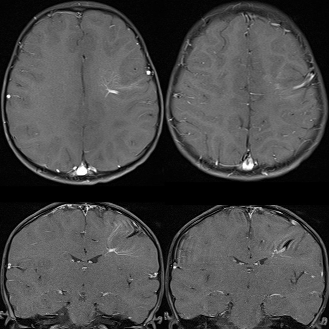 Developmental Venous Anomaly