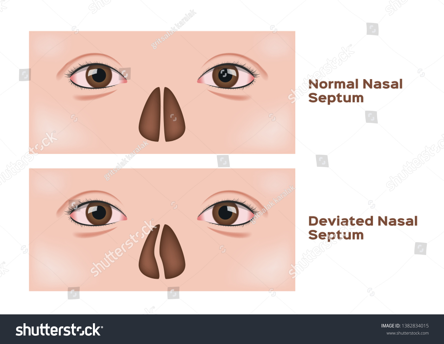 Deviated Nasal Septum Surgery