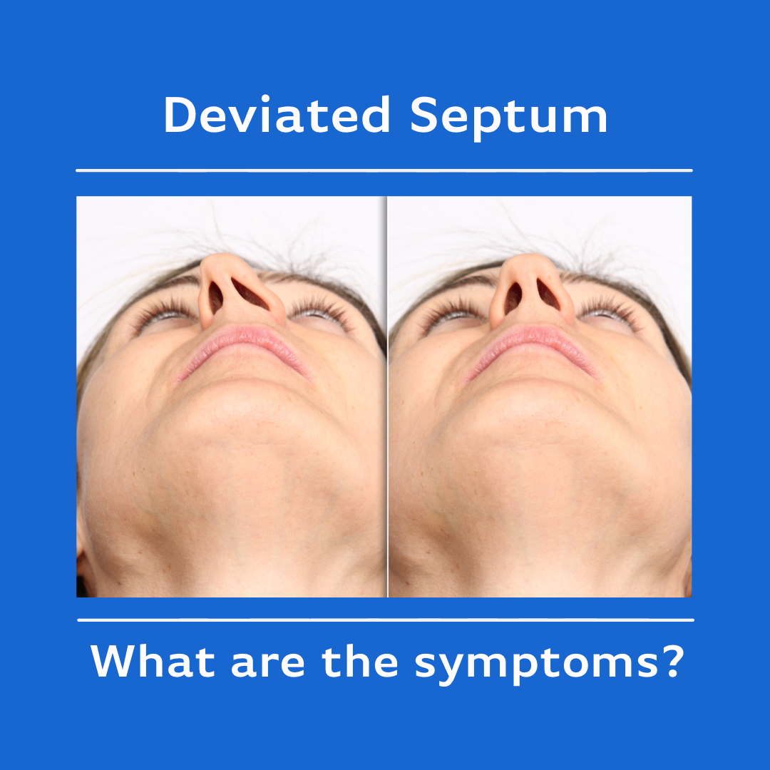 Deviated Septum Pictures