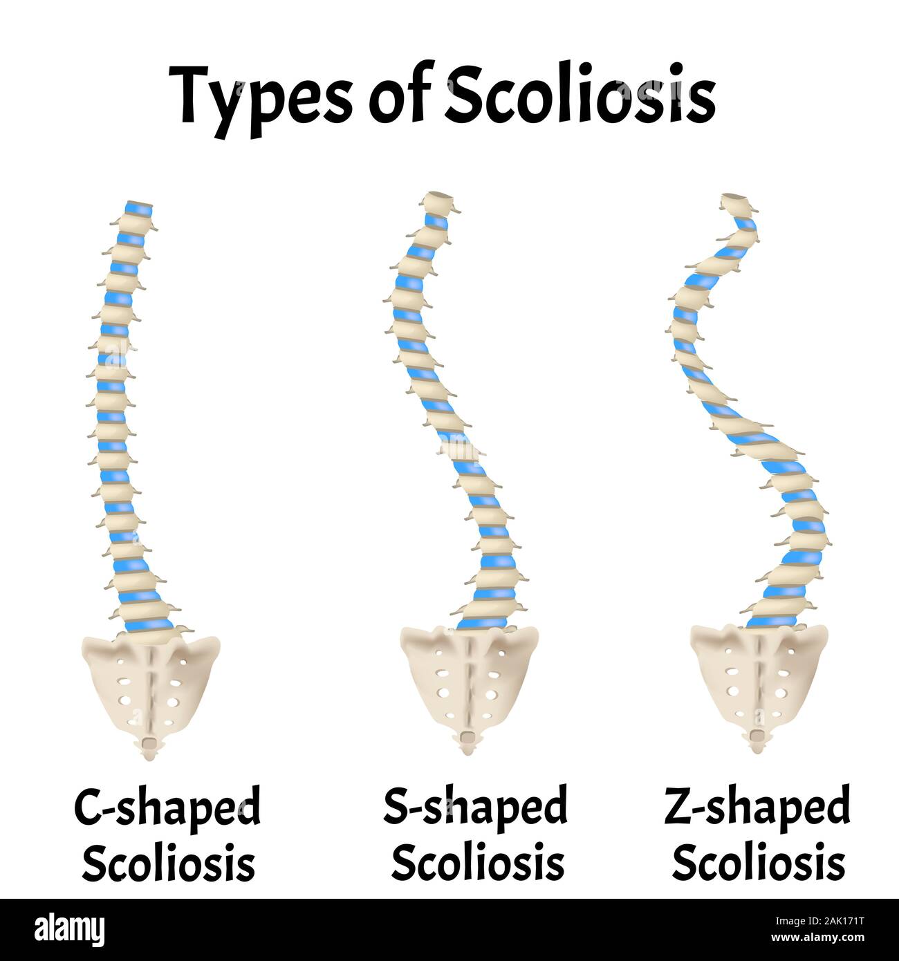 Dextro Vs Levoscoliosis