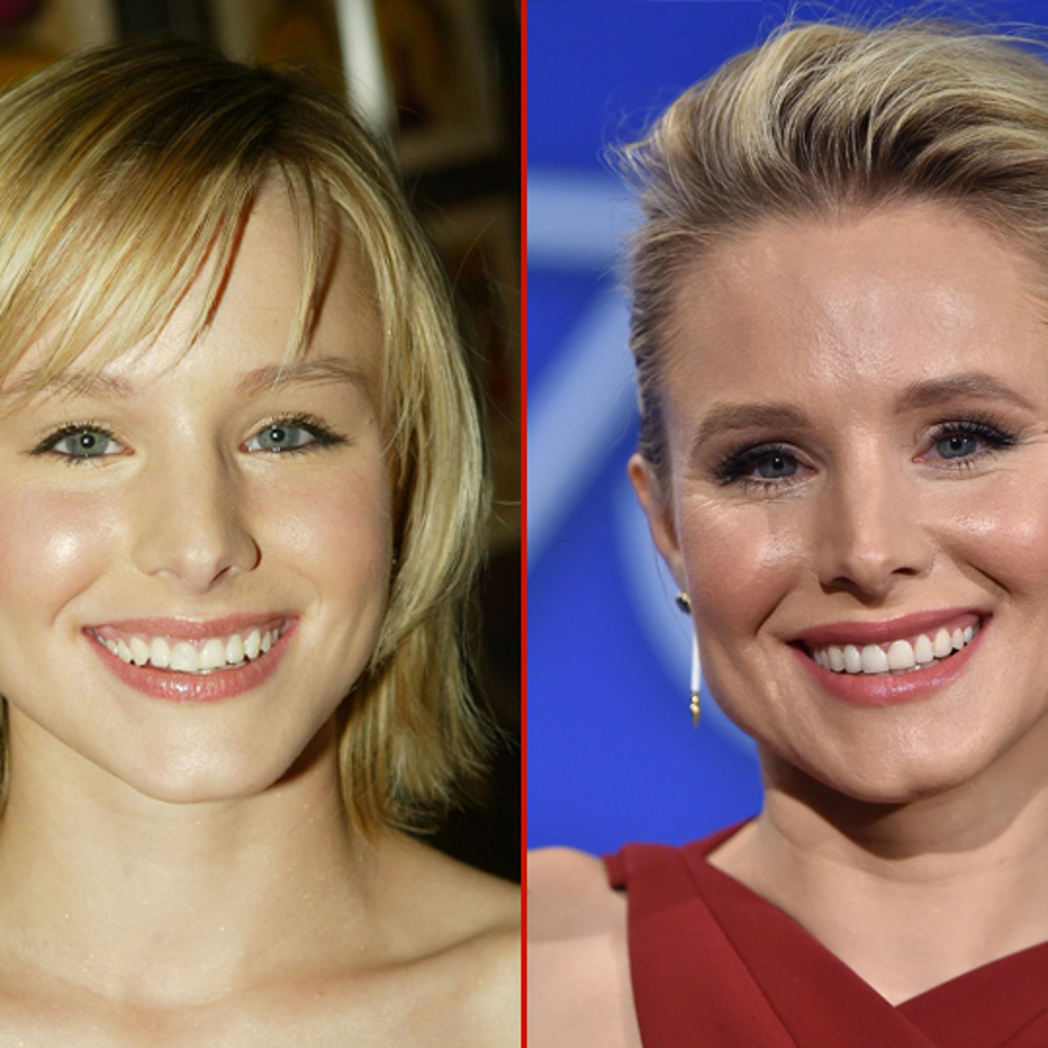Did Kristen Bell Have Face Surgery