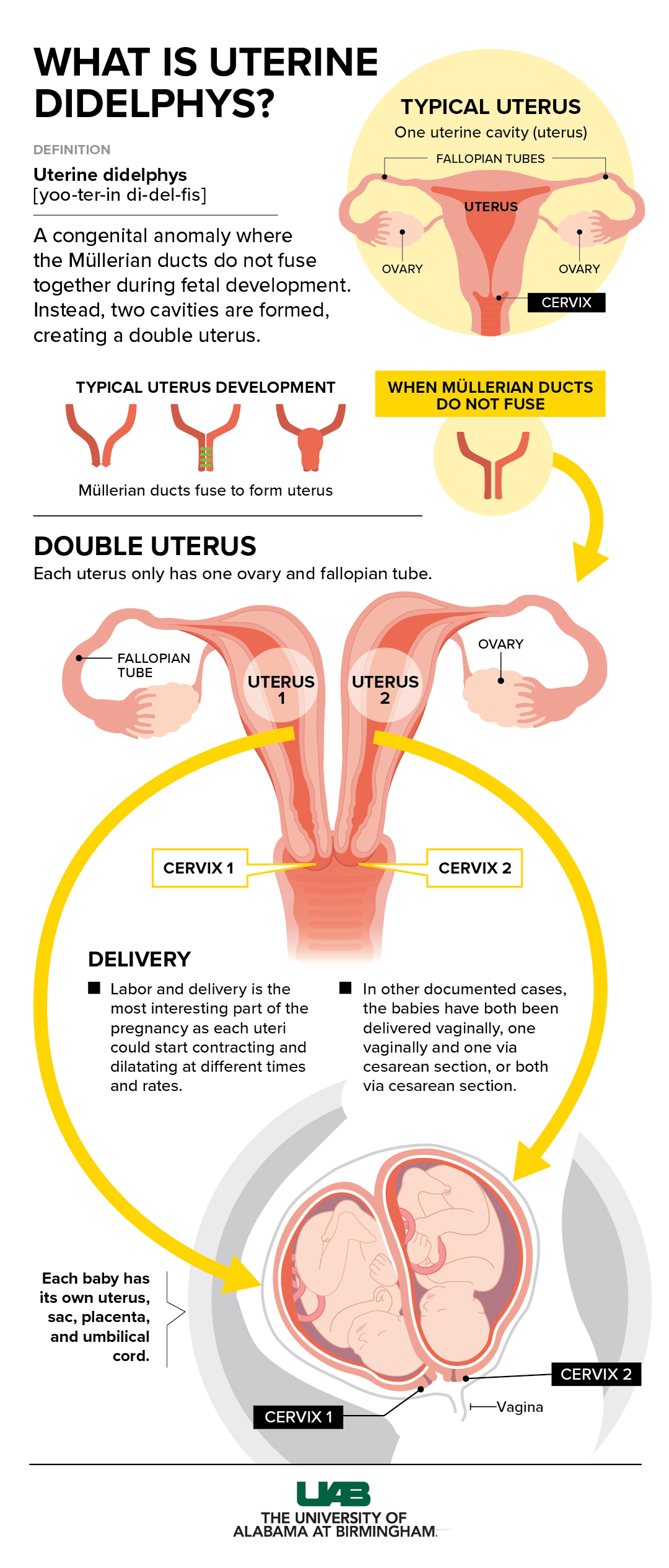 Didelphic Uterus Images