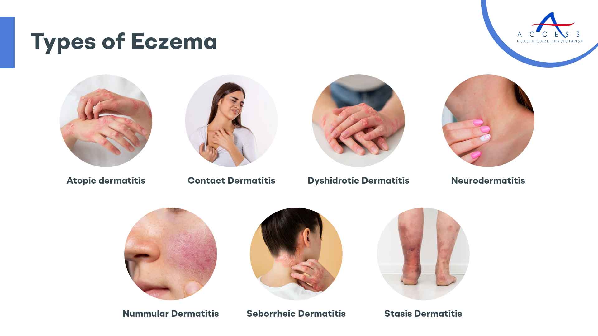 Different Kinds Of Eczema