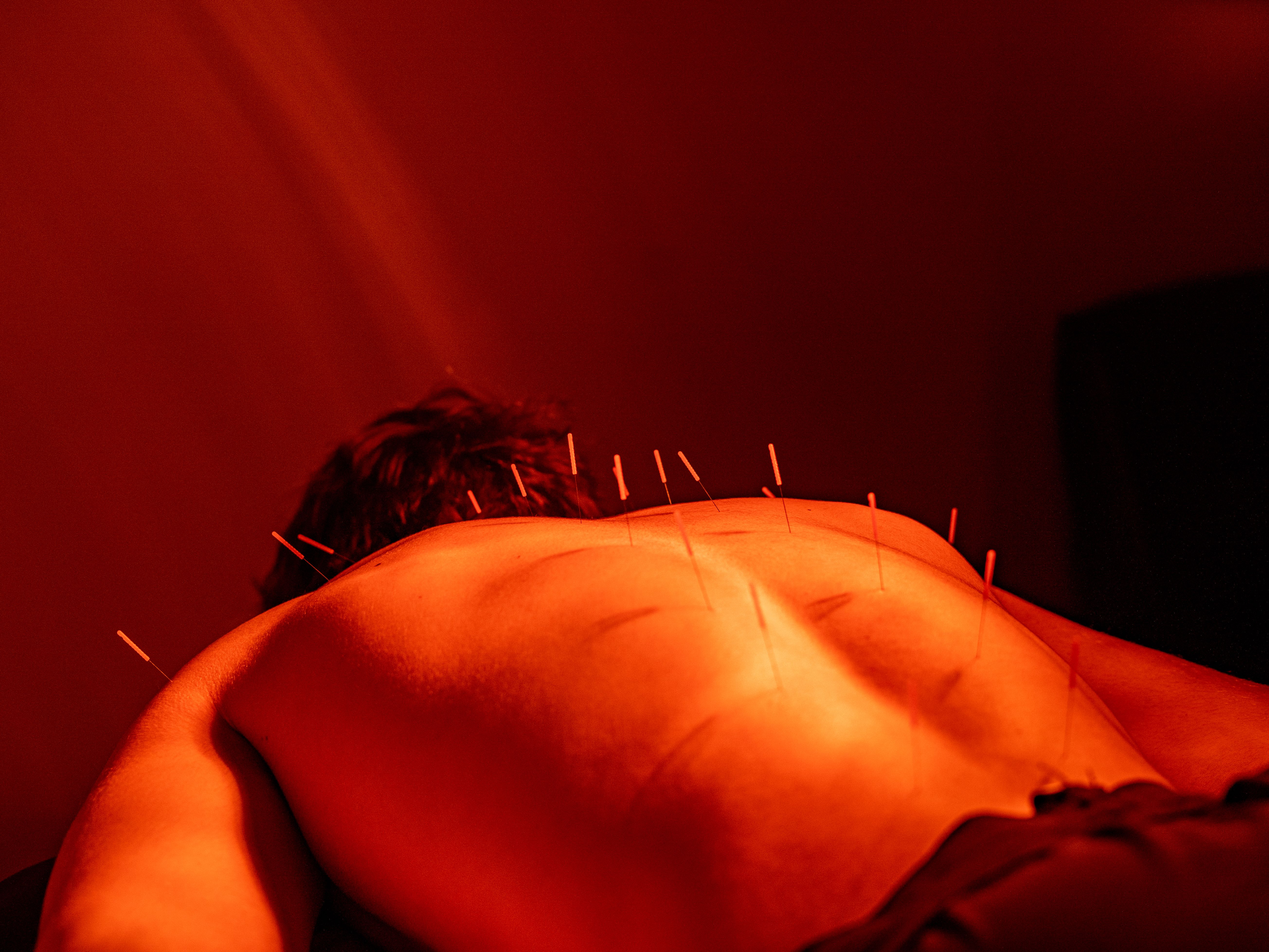 Disadvantages Of Acupuncture