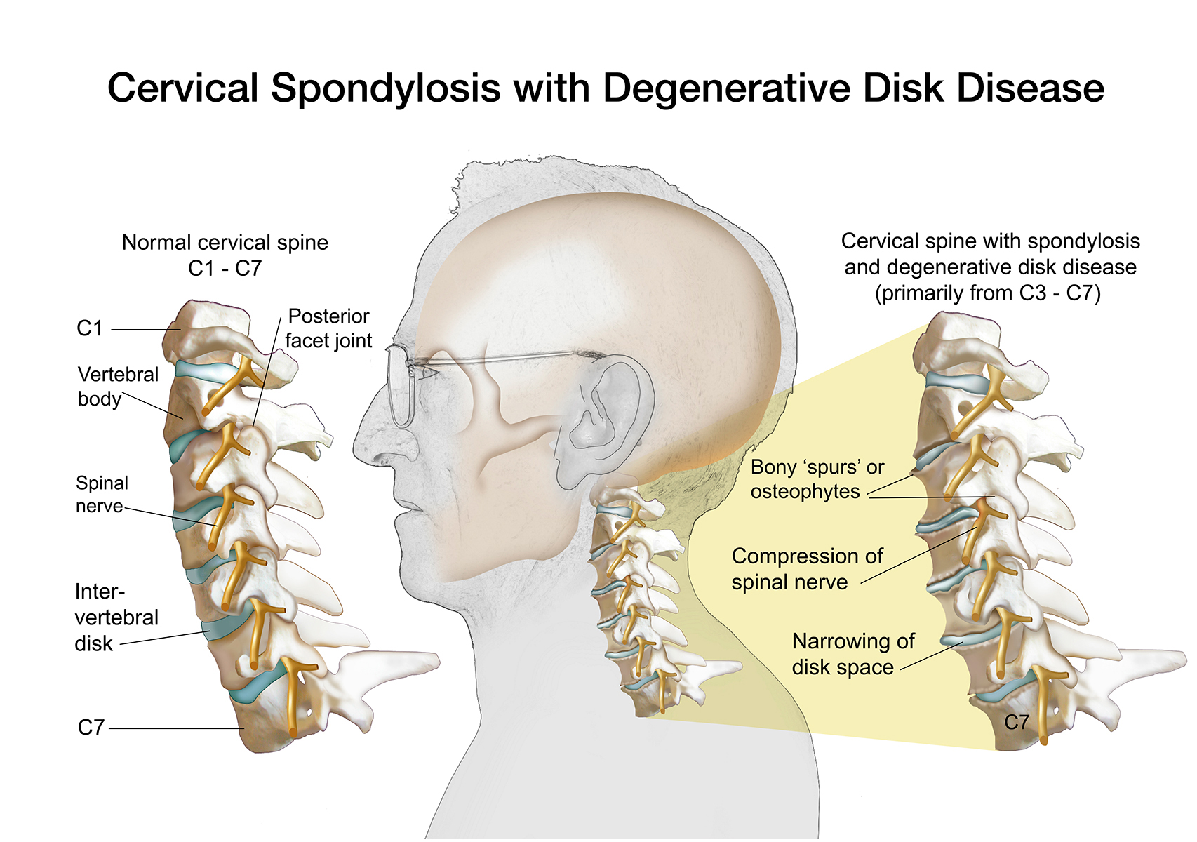 Disk Disease Neck