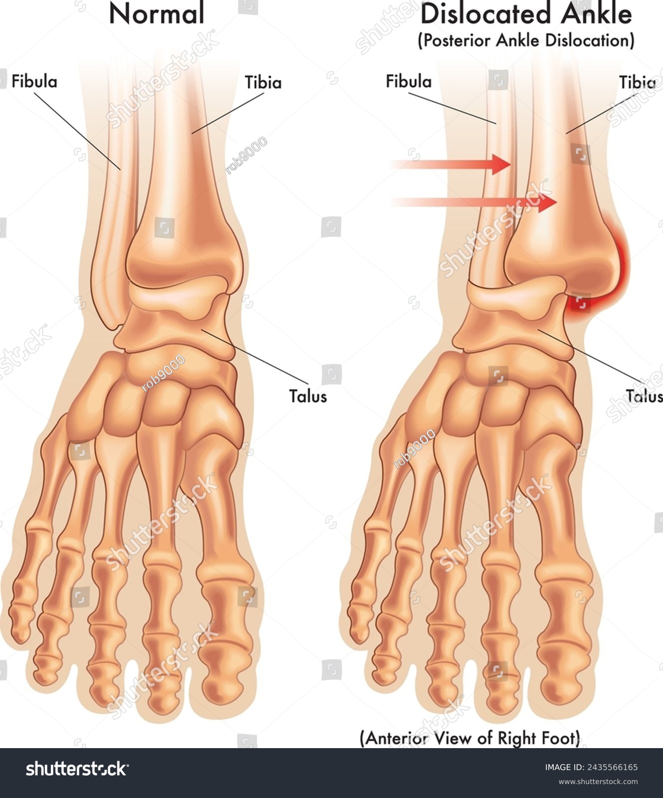Dislocated Ankle Recovery Time