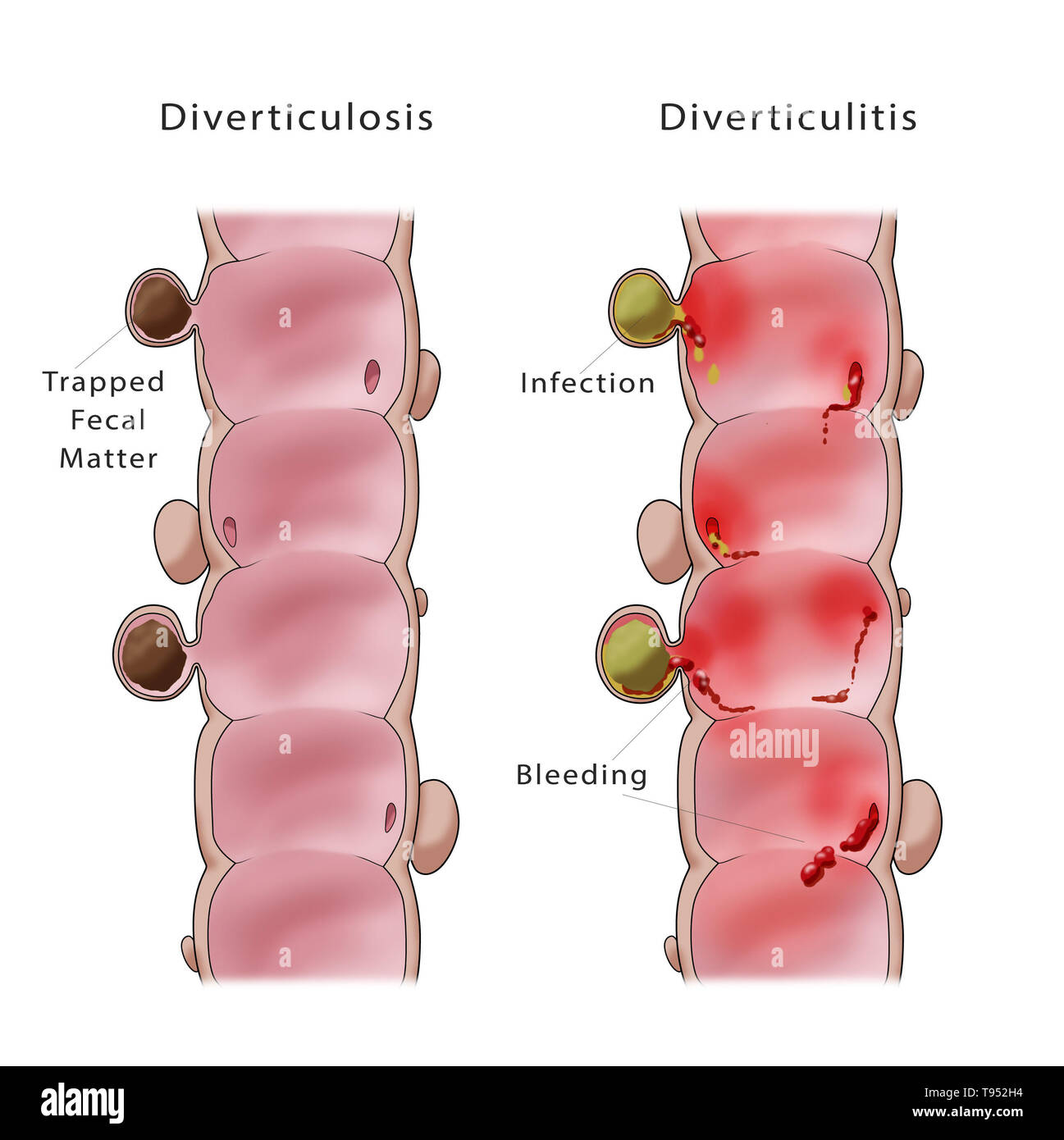 Diverticulitis Vs Diverticulosis