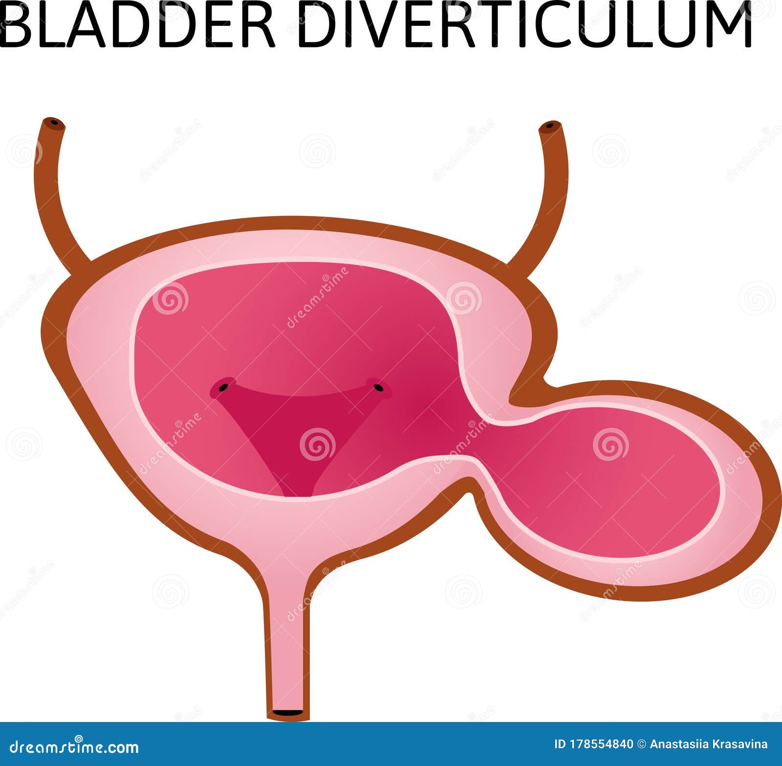 Diverticulum On Bladder