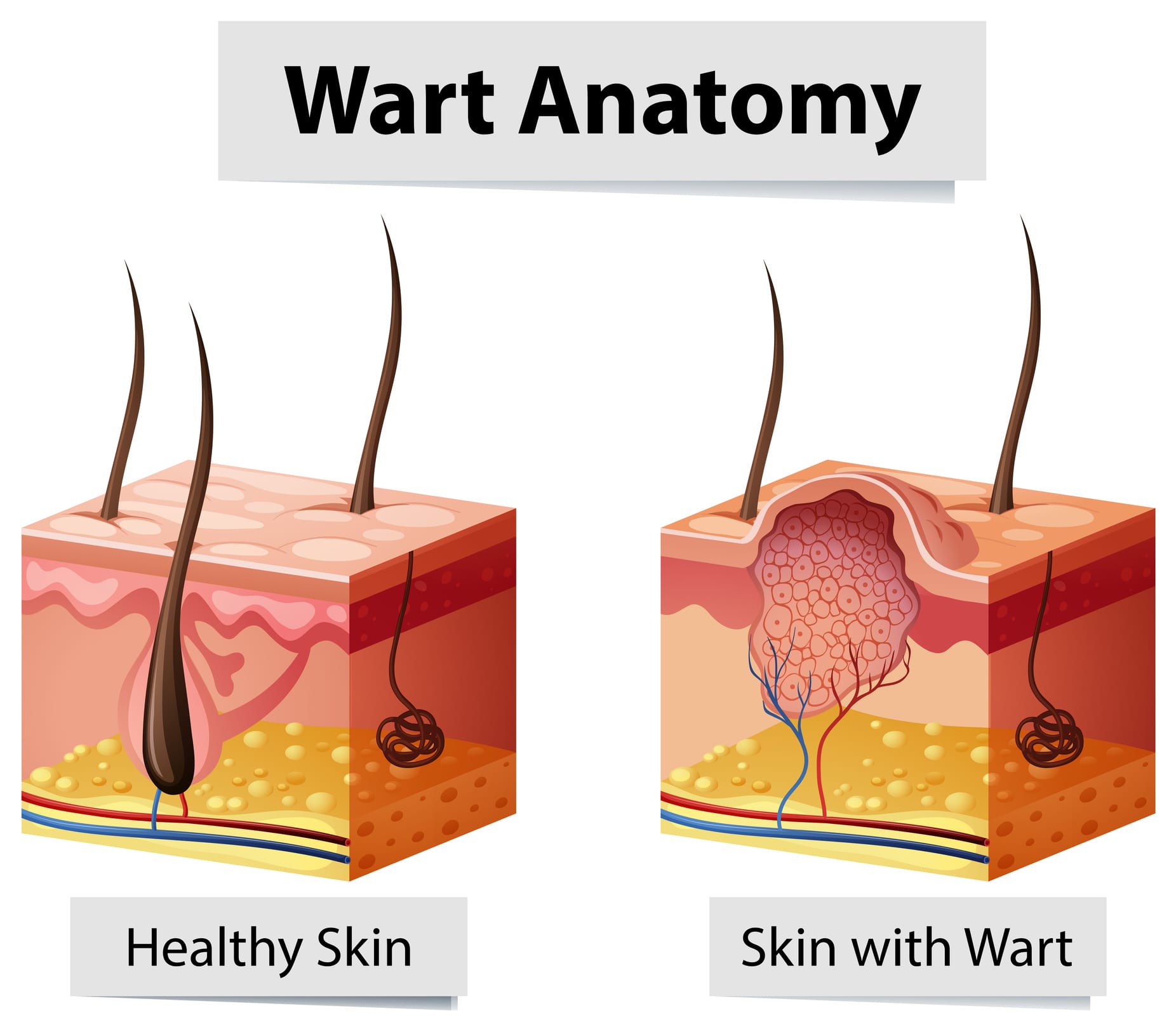 Do Anal Warts Go Away