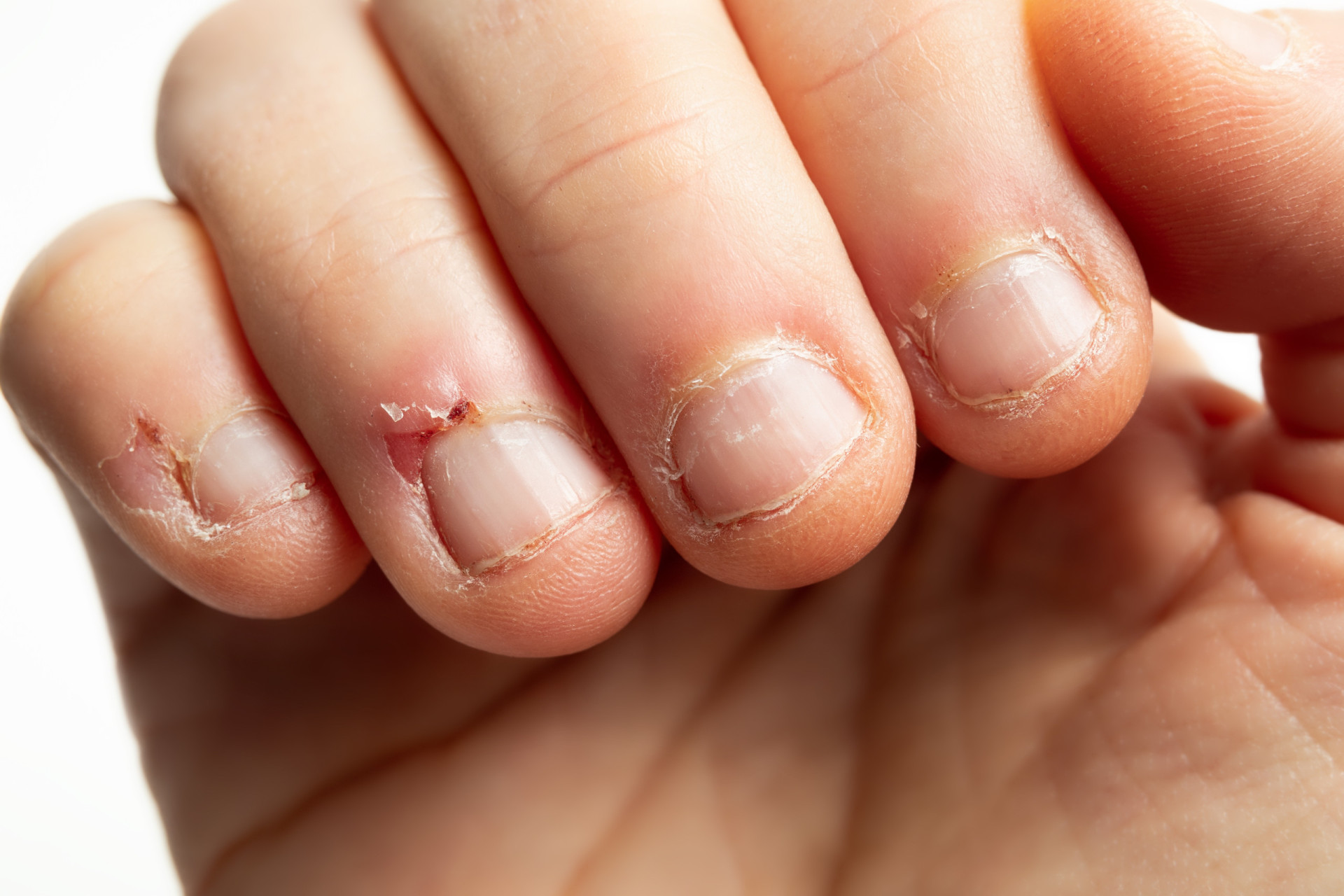 Do Autistic People Bite Nails