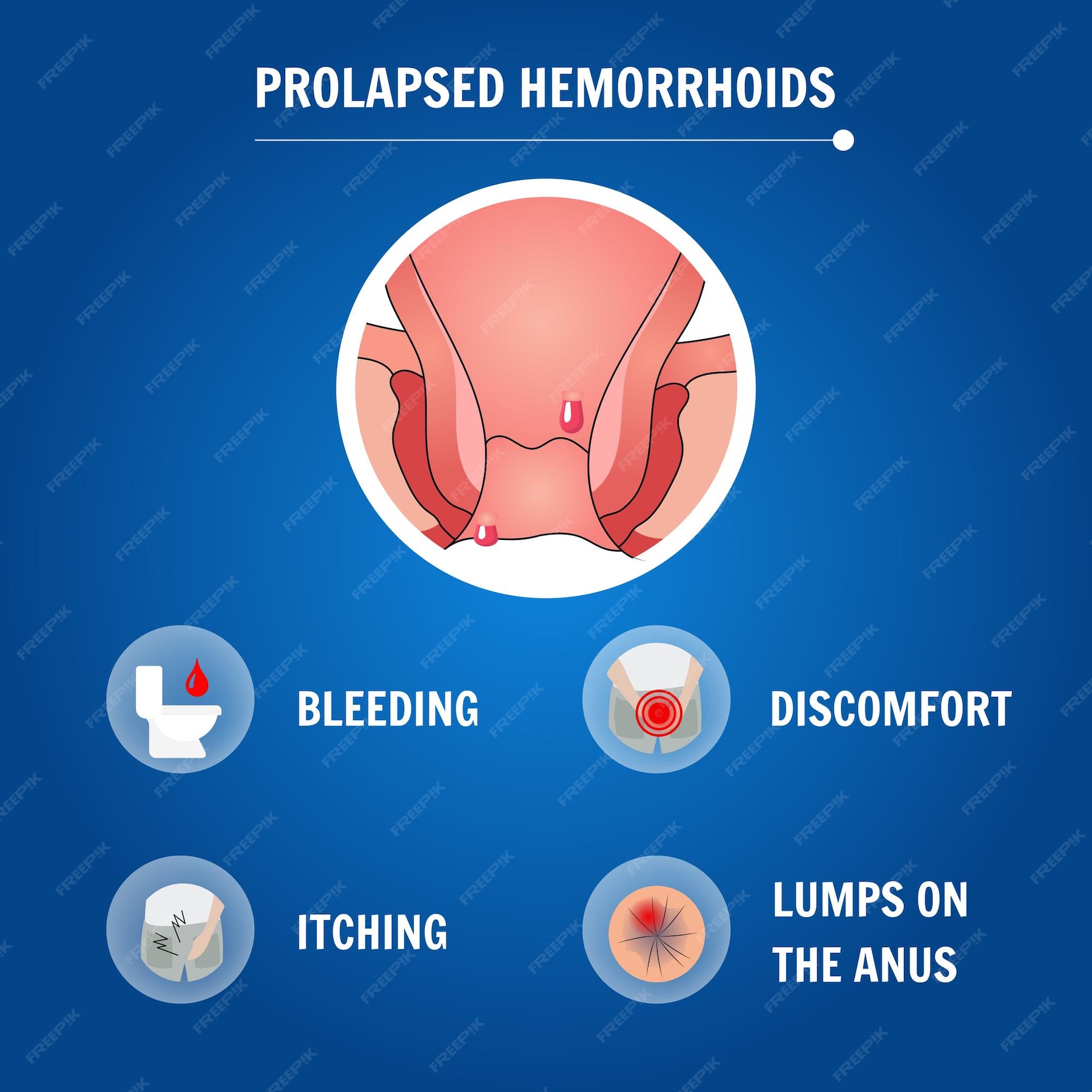 Do Hemorrhoids Pop