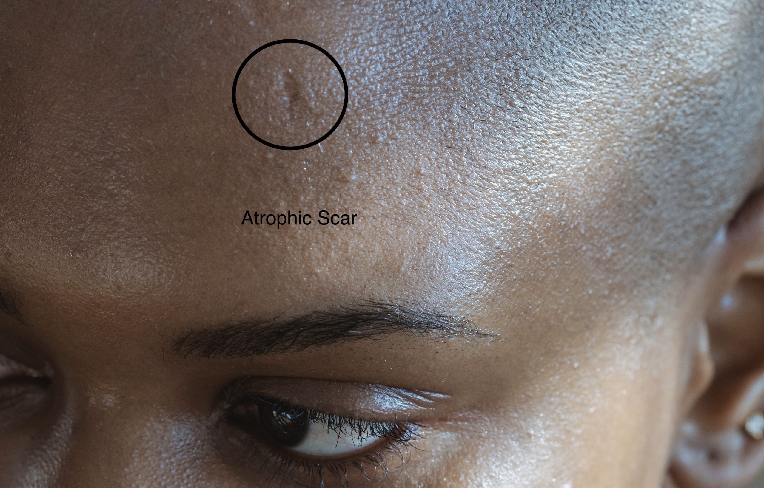 Do Pimple Scars Go Away