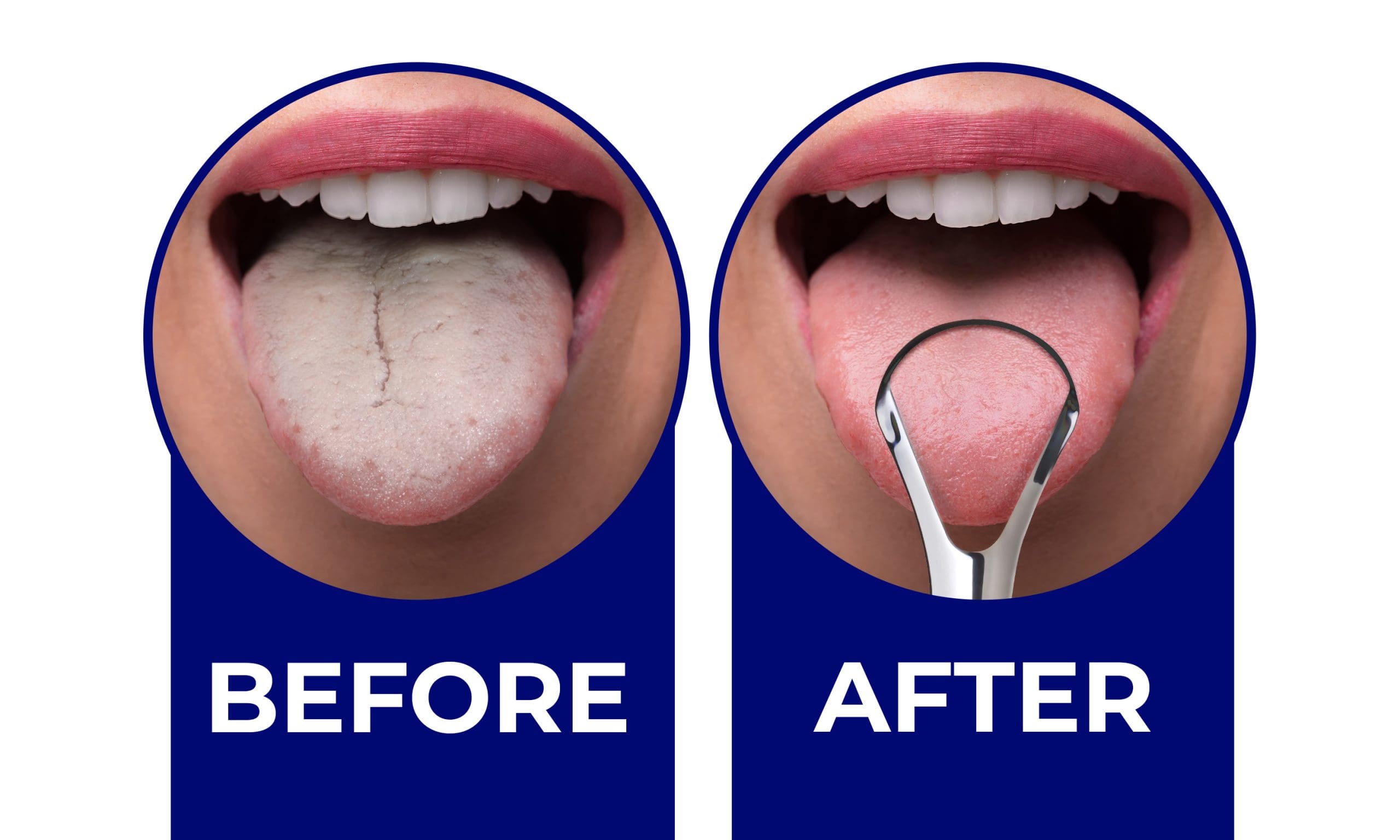 Do Tongue Scrapers Work
