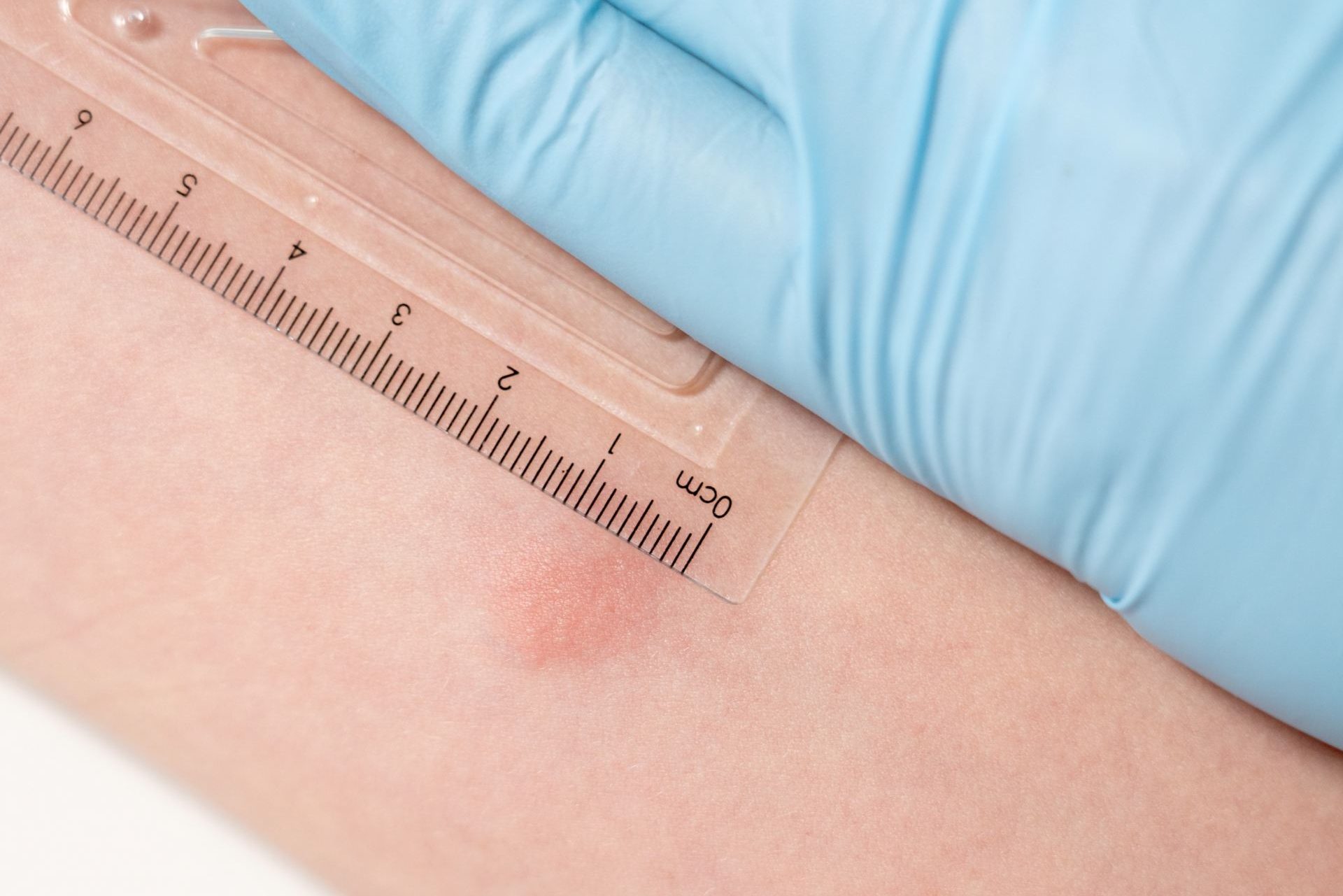 Does A Tuberculosis Test Hurt