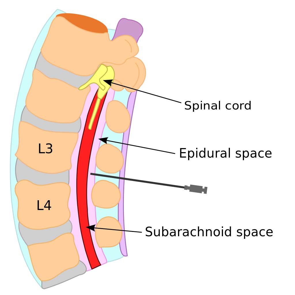 Does Epidural Cause Back Problems